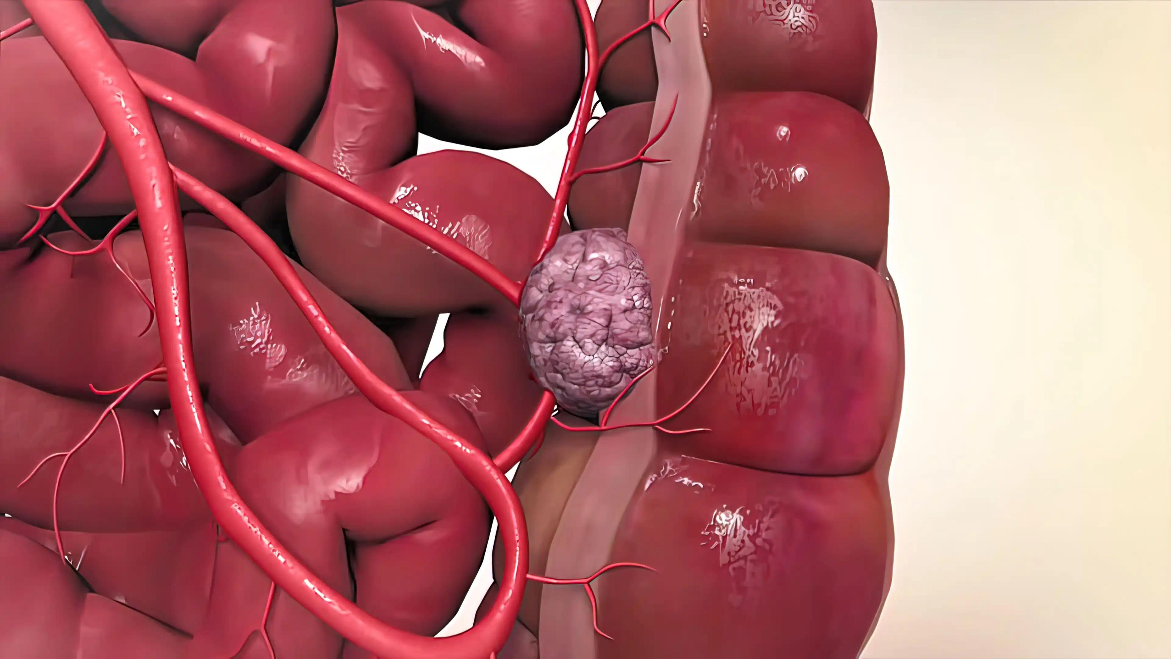 3d illusion Advanced Colon Cancer Tumor