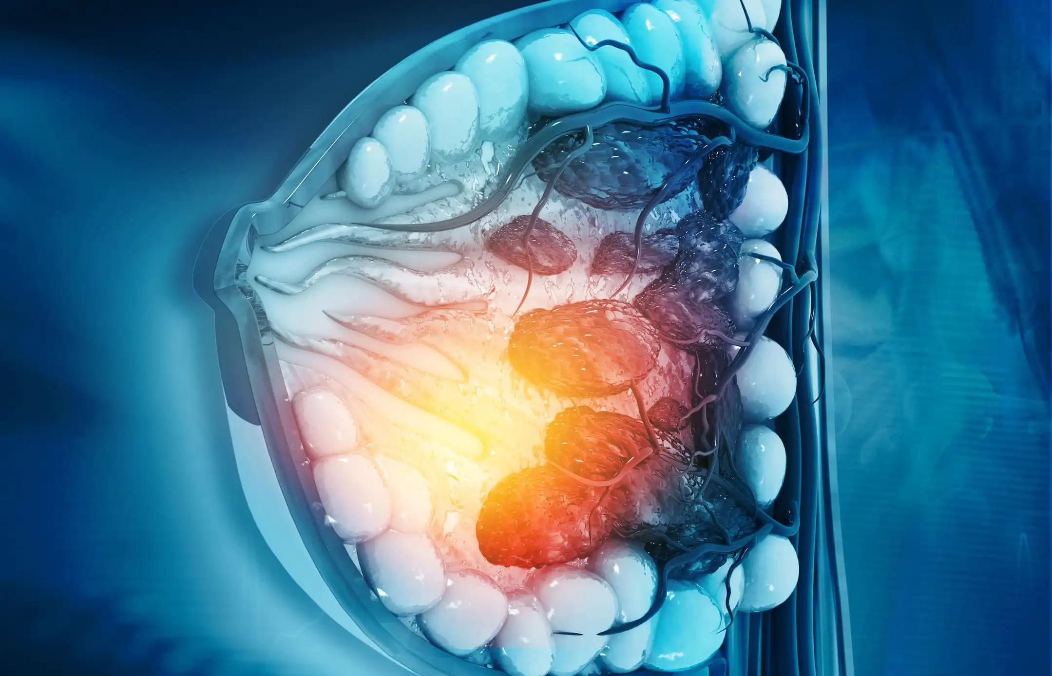 3d illustratio Cross Section of Female Breast Cancer