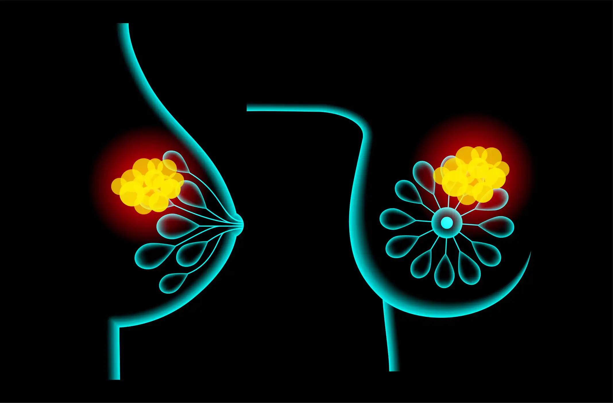 3D illustration Breast Cancer Cell