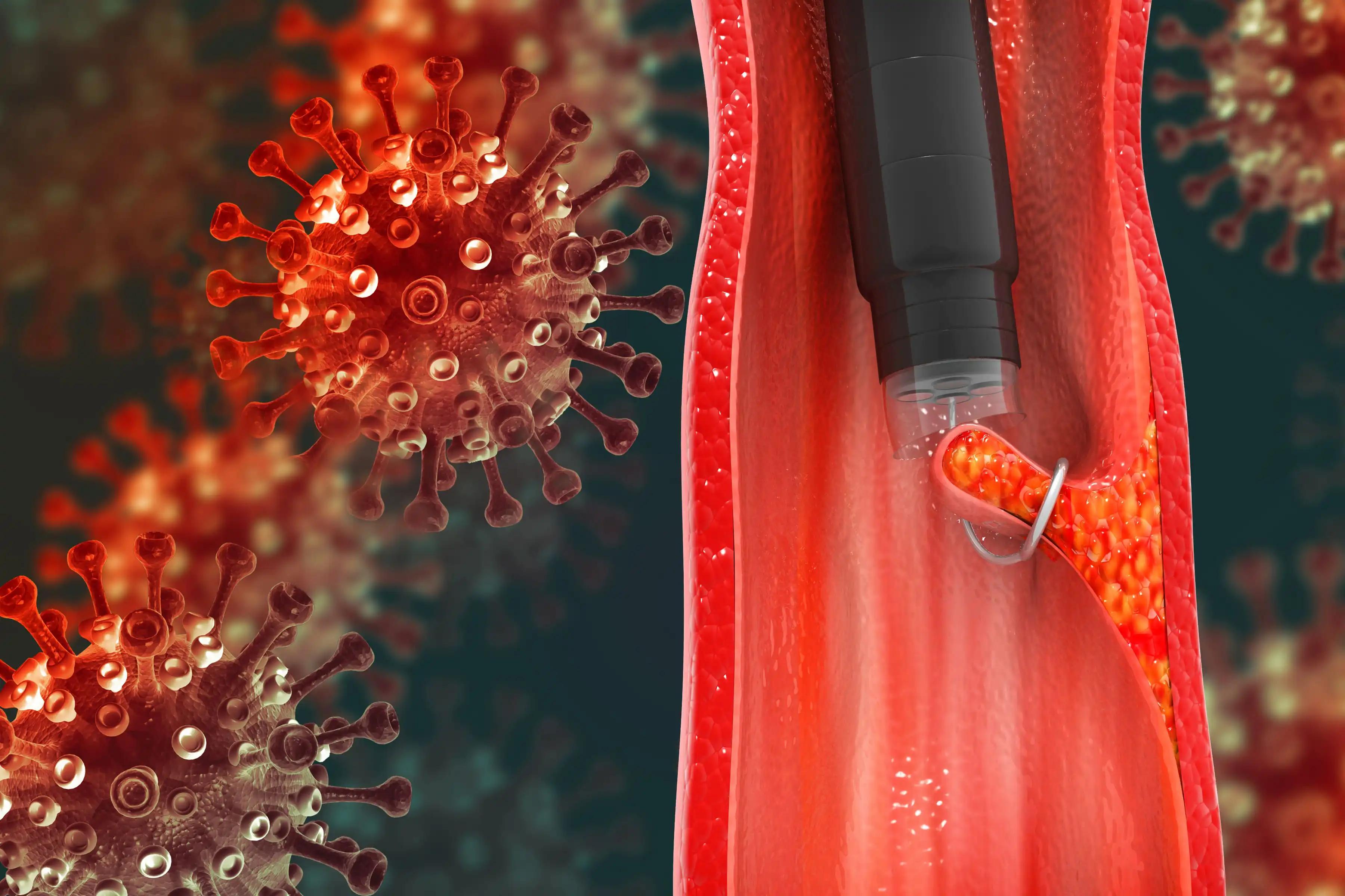 3D illustration Endoscope Inside Colonoscopy for Colon Polyps