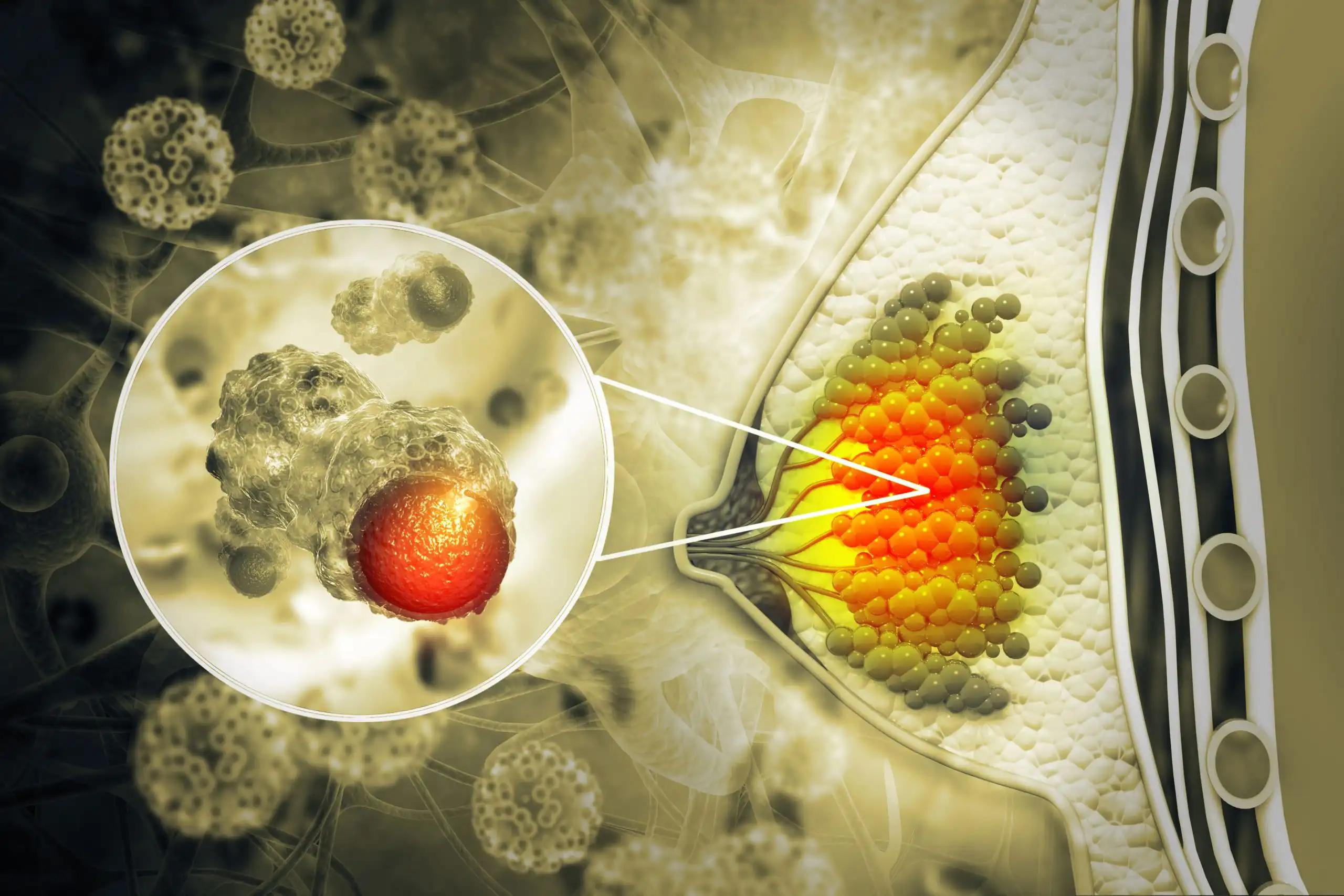 3d illustration of Breast with Cancer Focus of Inflammation