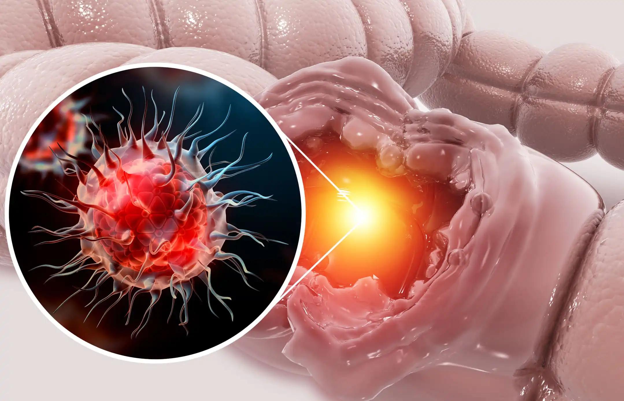 3d illustration of Colon Cancer Attacking Cell