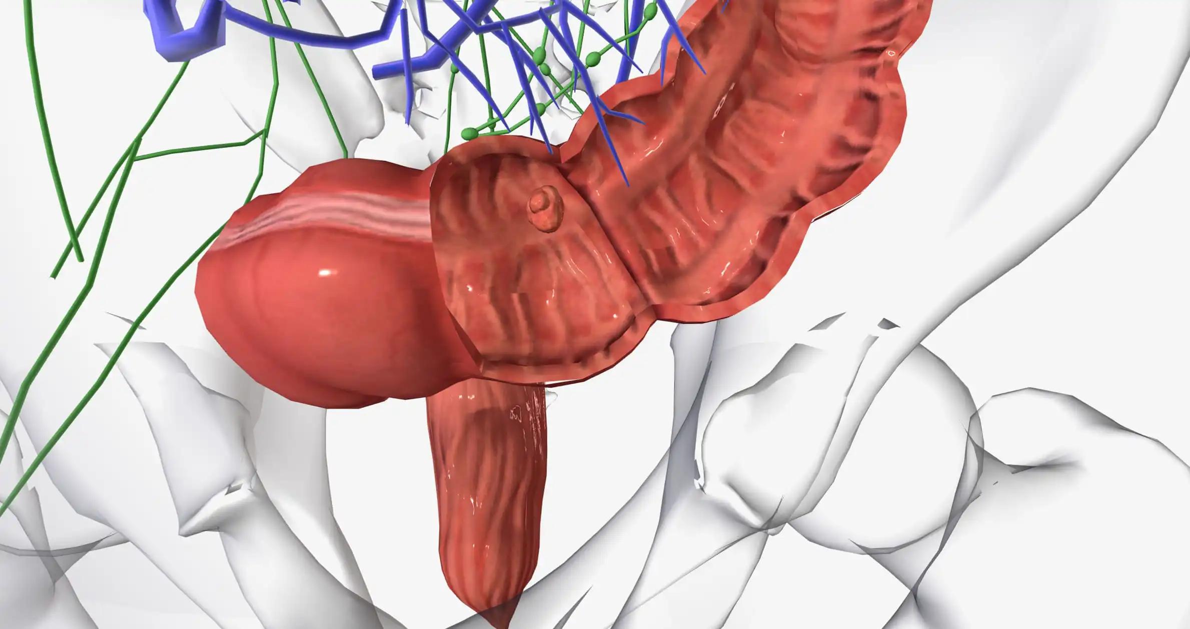 3D Rendering of Colorectal Cancer