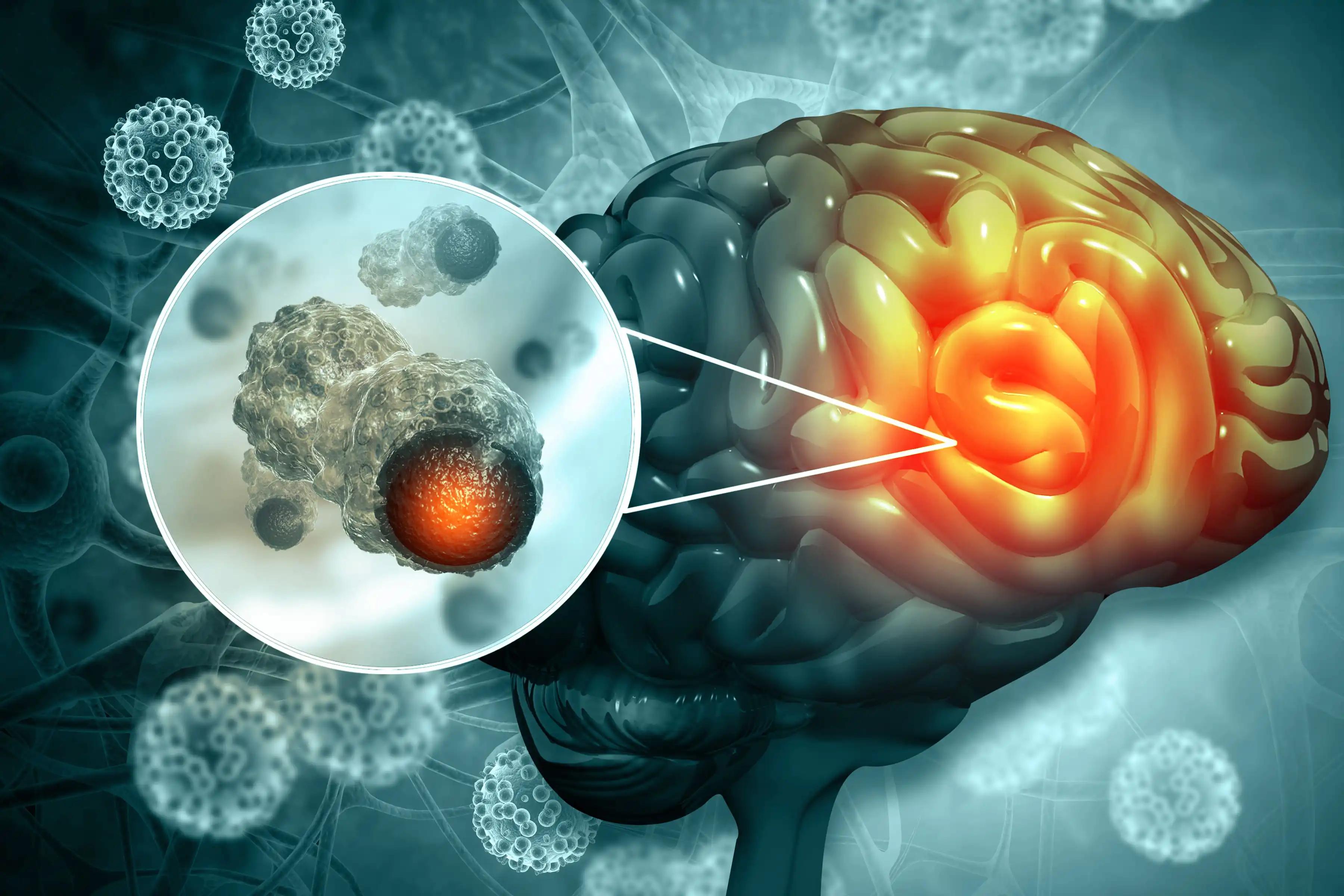 3D View of Brain Tumor Microenvironment with Tissue