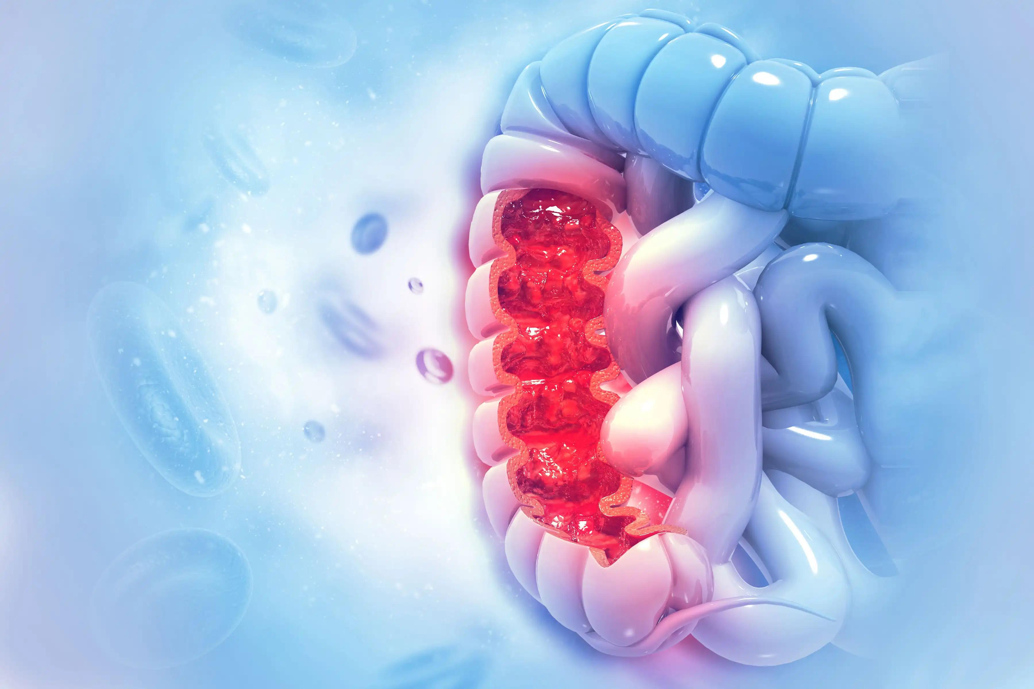 3D View of Colorectal Cancer Infection