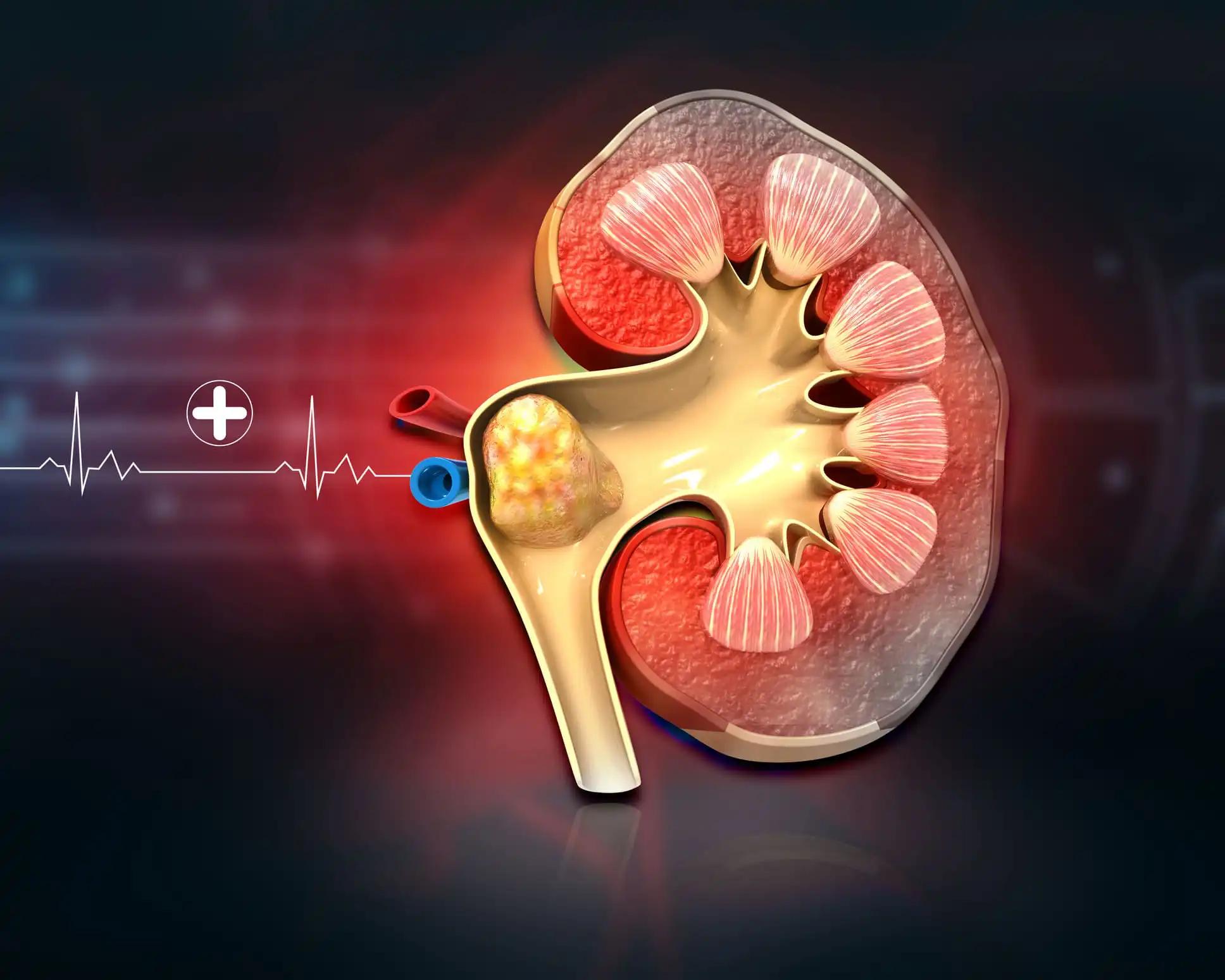 3D View of Deceased Kidney