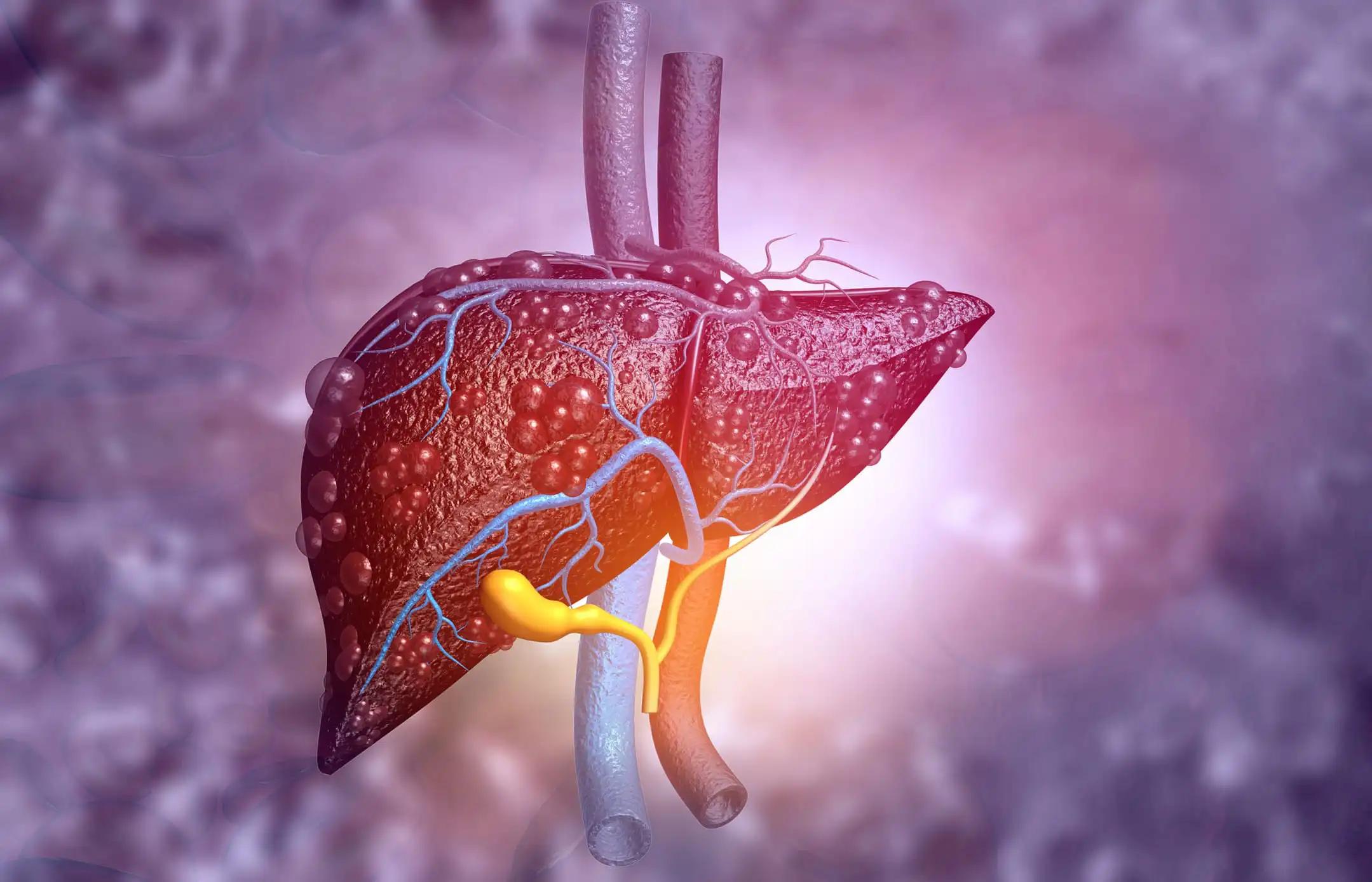 3D VIew of Hepatocellular Carcinoma