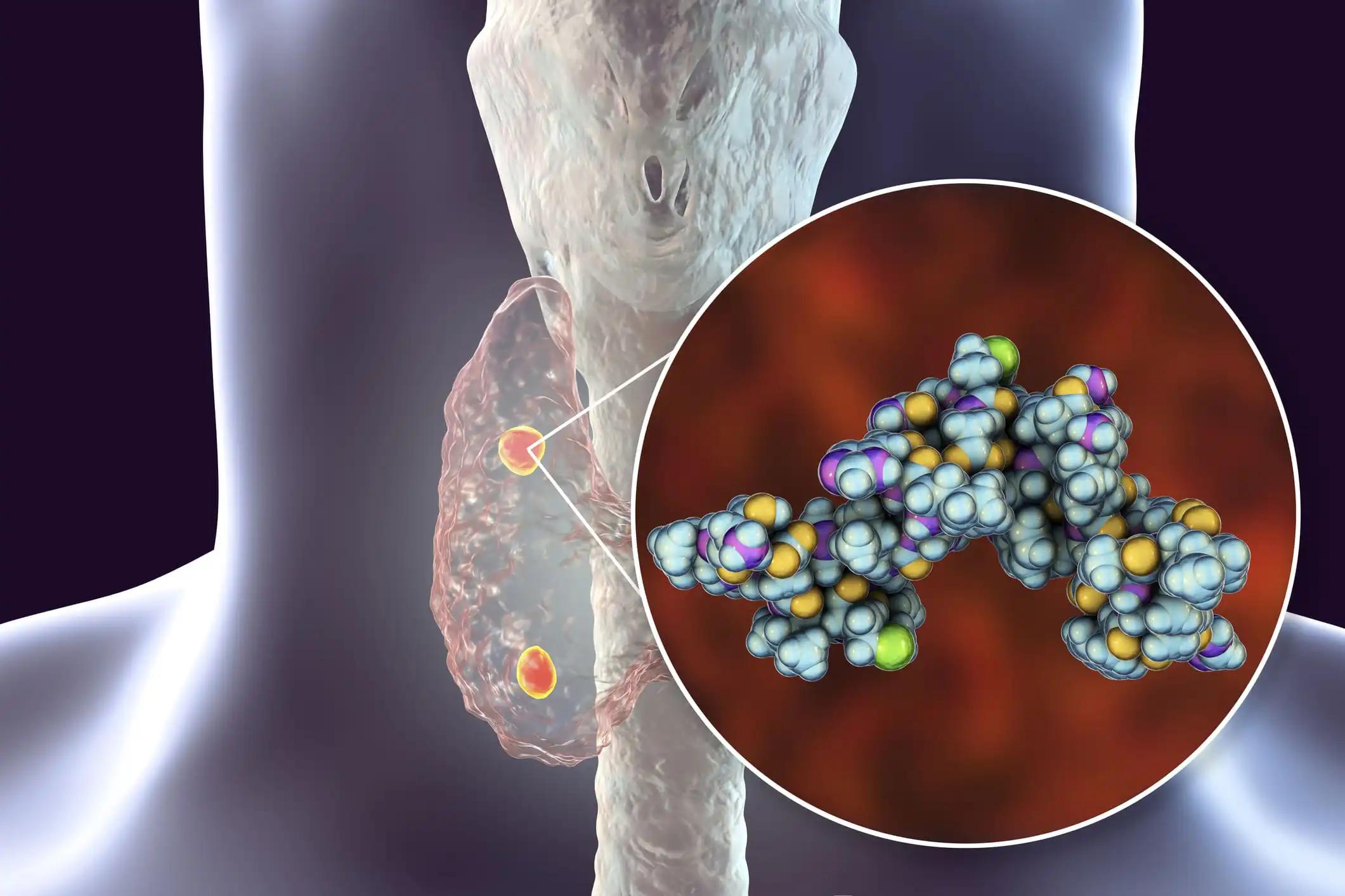 3D View of Hyperparathyroidism Infection