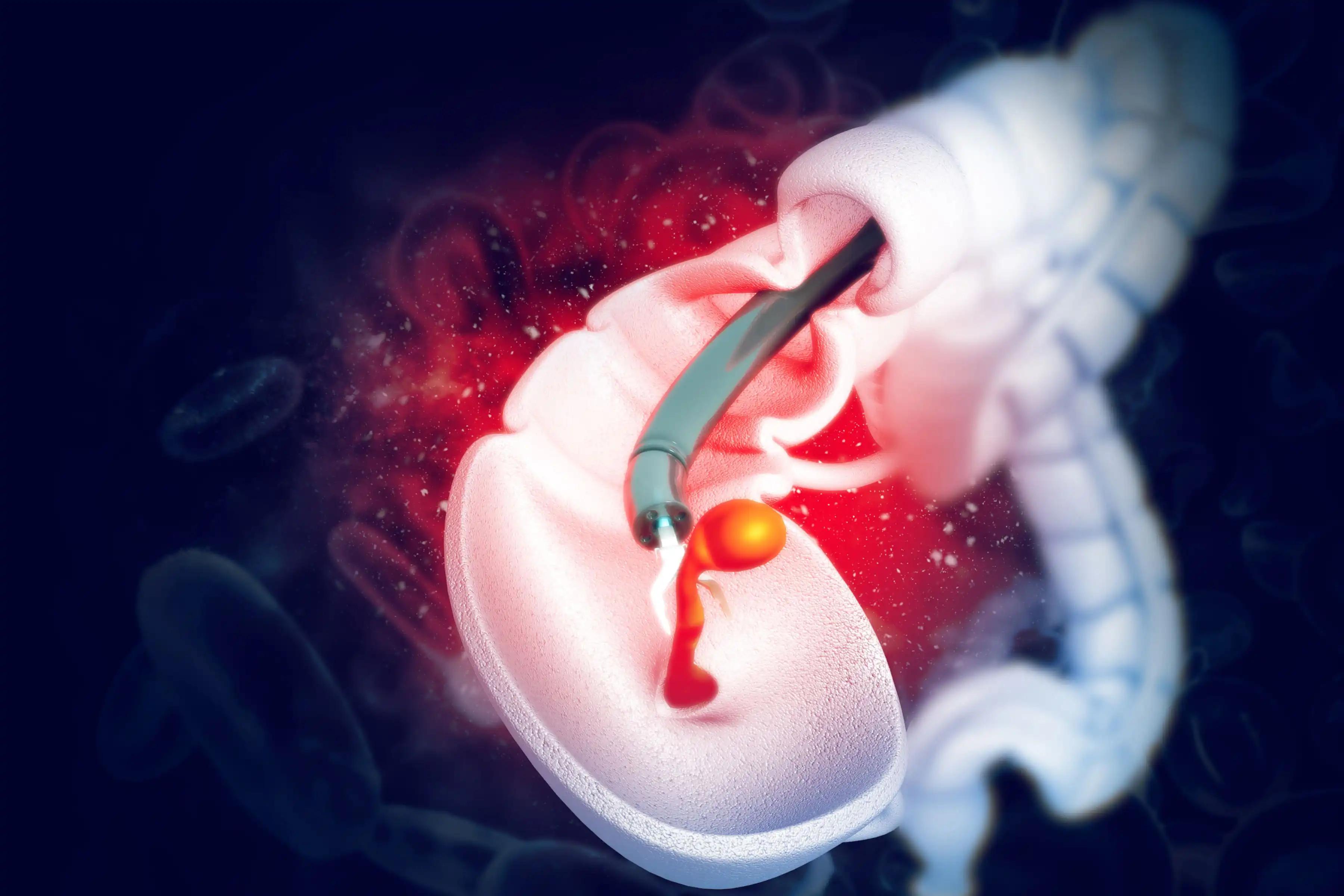 3D View of Therapeutic Endoscopic of Colorectal Cancer