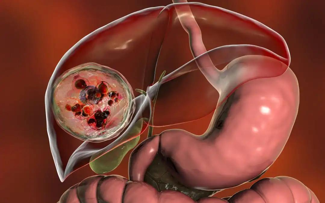 Improved PFS With Len + Pembro + TACE in Intermediate HCC