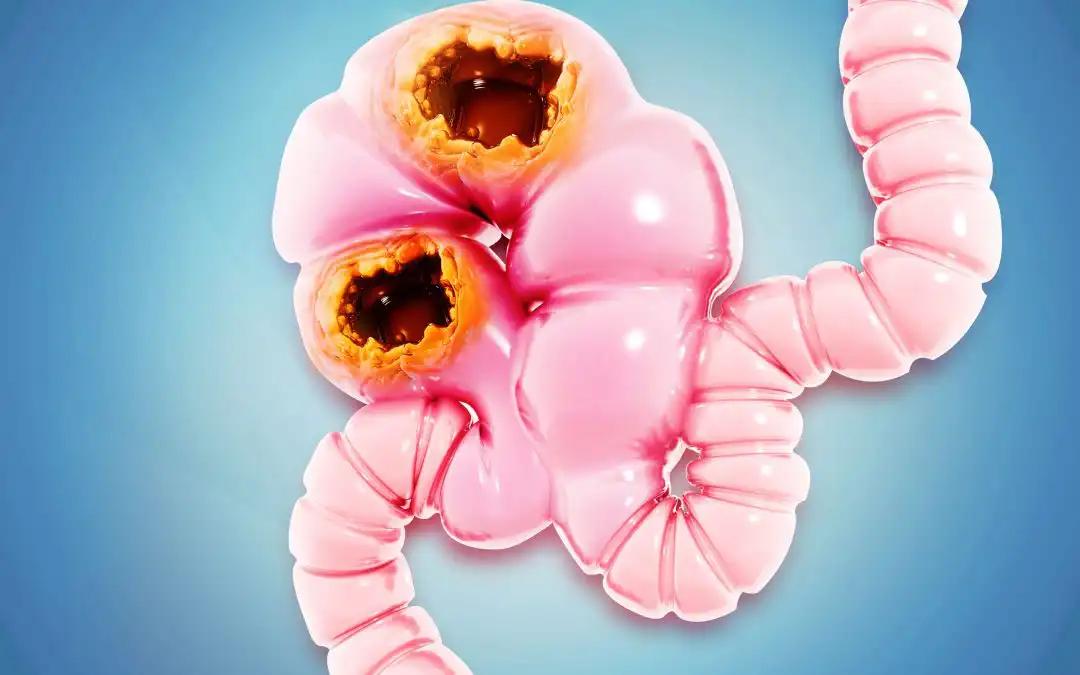 Ipilimumab & Nivolumab Achieve 100% DFS in dMMR Colon Cancer