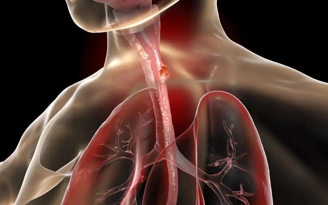 Long-term Outcomes of LTG vs OTG in AGC After NACT