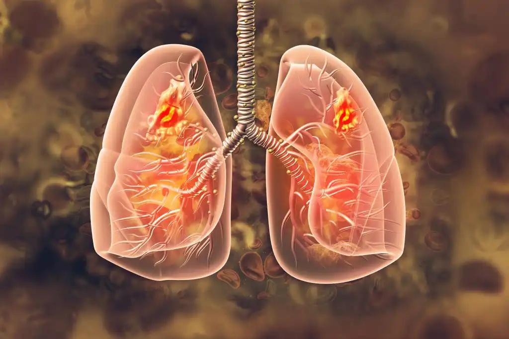 Extensive Stage Small-Cell Lung Cancer Immunotherapy