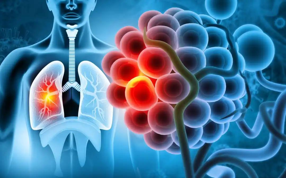 Prognostic Value of TSR in Chemotherapy-Treated SCLC