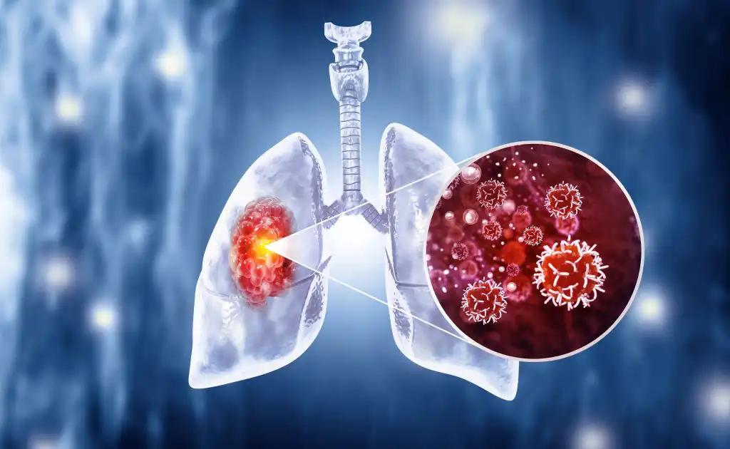 Non-Small Cell Lung Cancer Tumor Infection