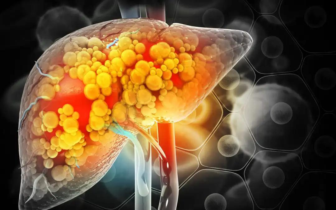 SERGs Model for Prognosis and Treatment in HCC