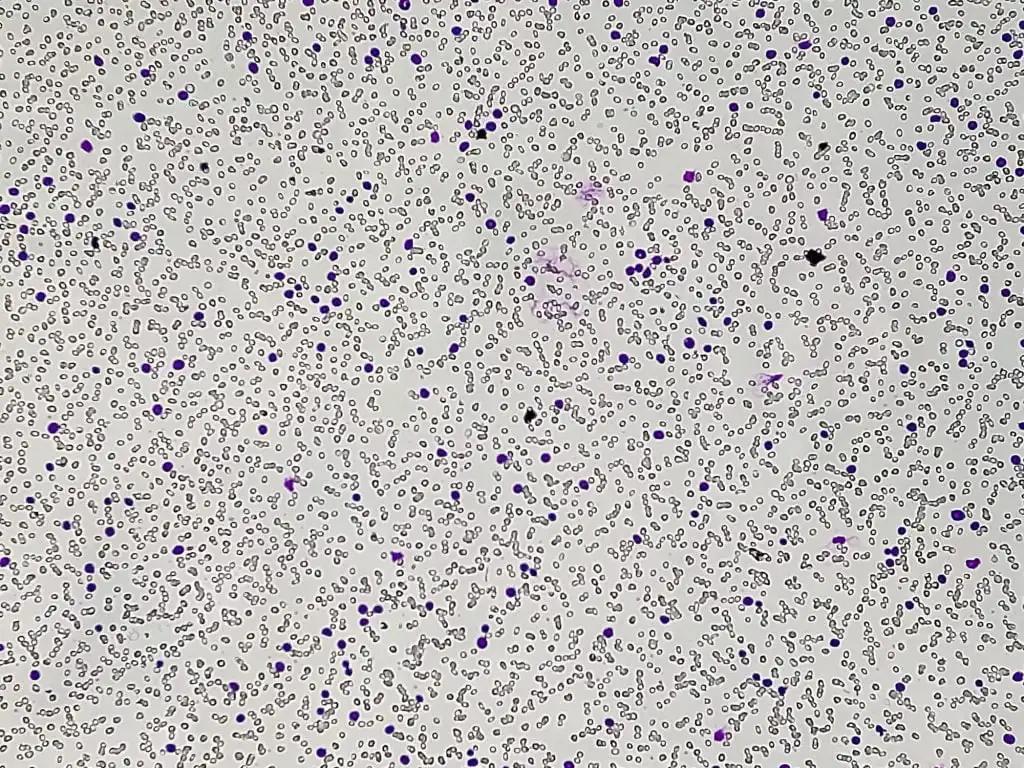 Chronic Lymphocytic Leukemia Cells