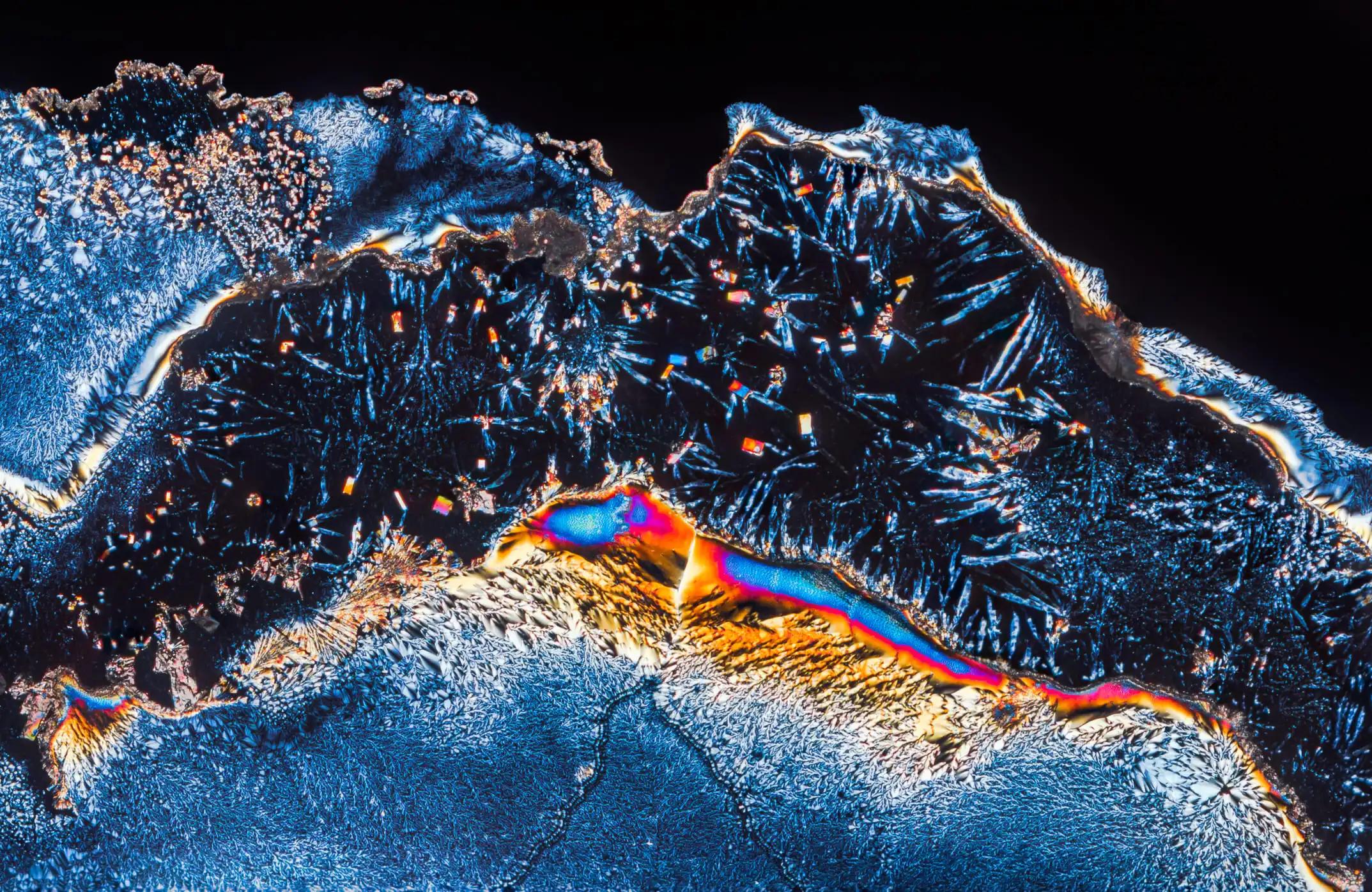 Mantle Lymphoma Cells Under the Microscope