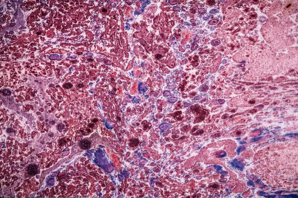 Marginal Zone Lymphoma Cells