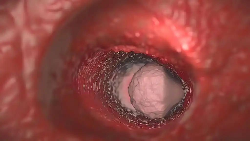 Melanoma Cancer Cell