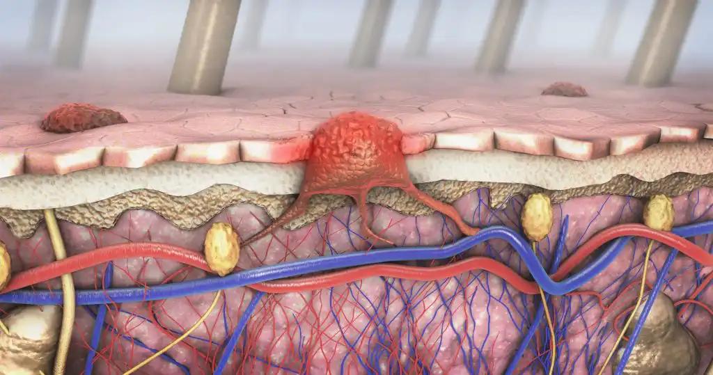 Metastasectomy in Advanced-Stage Melanoma