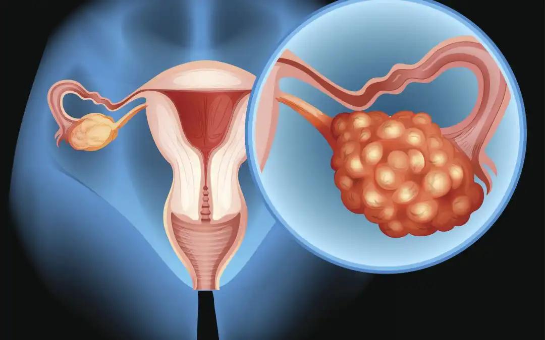 Enhancing OC Treatment With CD47/TSP-1 Axis