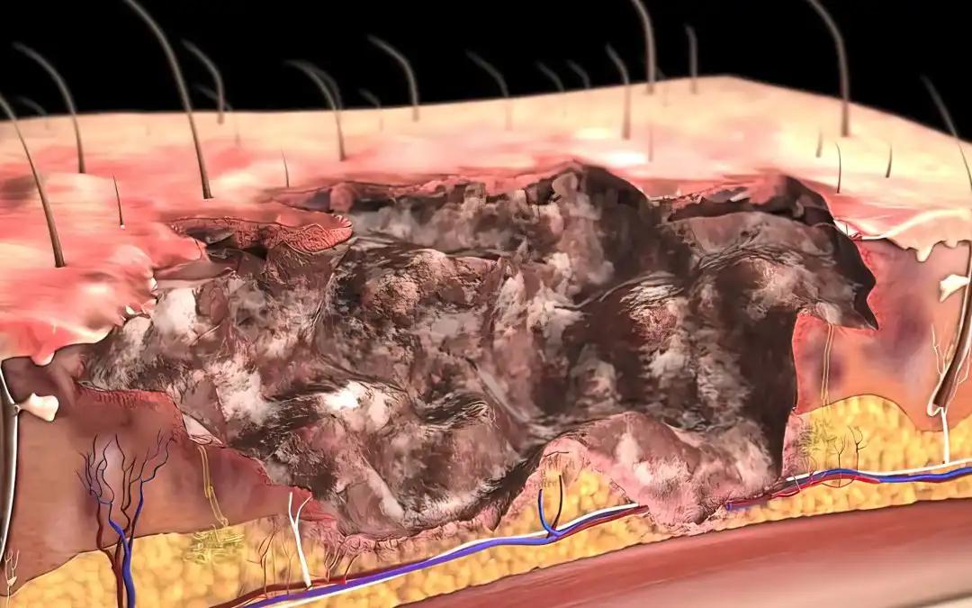 Prognostic Role of SOX2 and KLF4 in Oral SCC