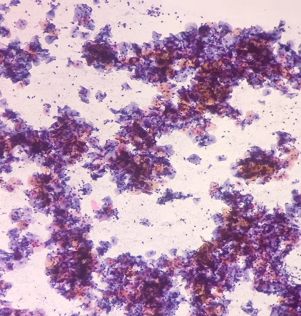 Squamous Epithelial Cells Abnormalities