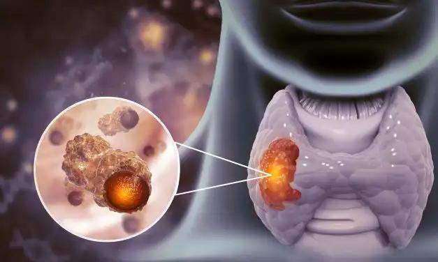 Understanding Risks for Esophageal Stricture After Esophagectomy