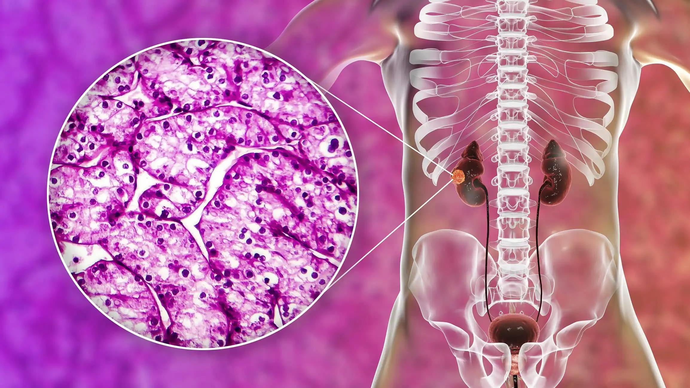 Adjuvant Therapy Renal Cell Carcinoma