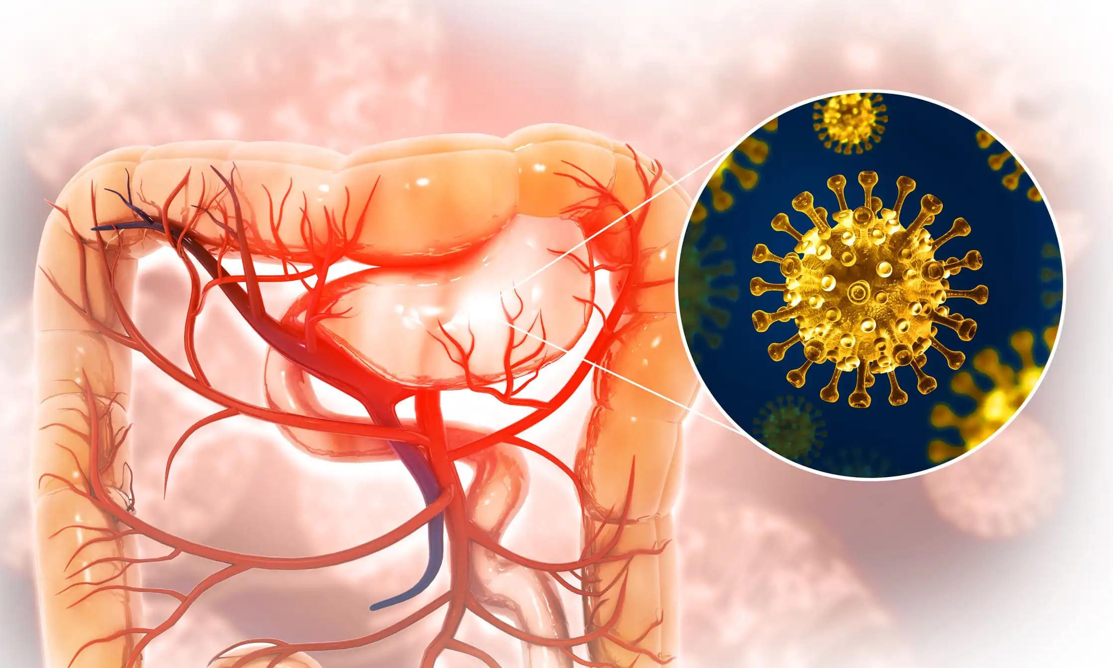 Impact of High-Dose Vitamin D on mCRC With Chemo+Bev