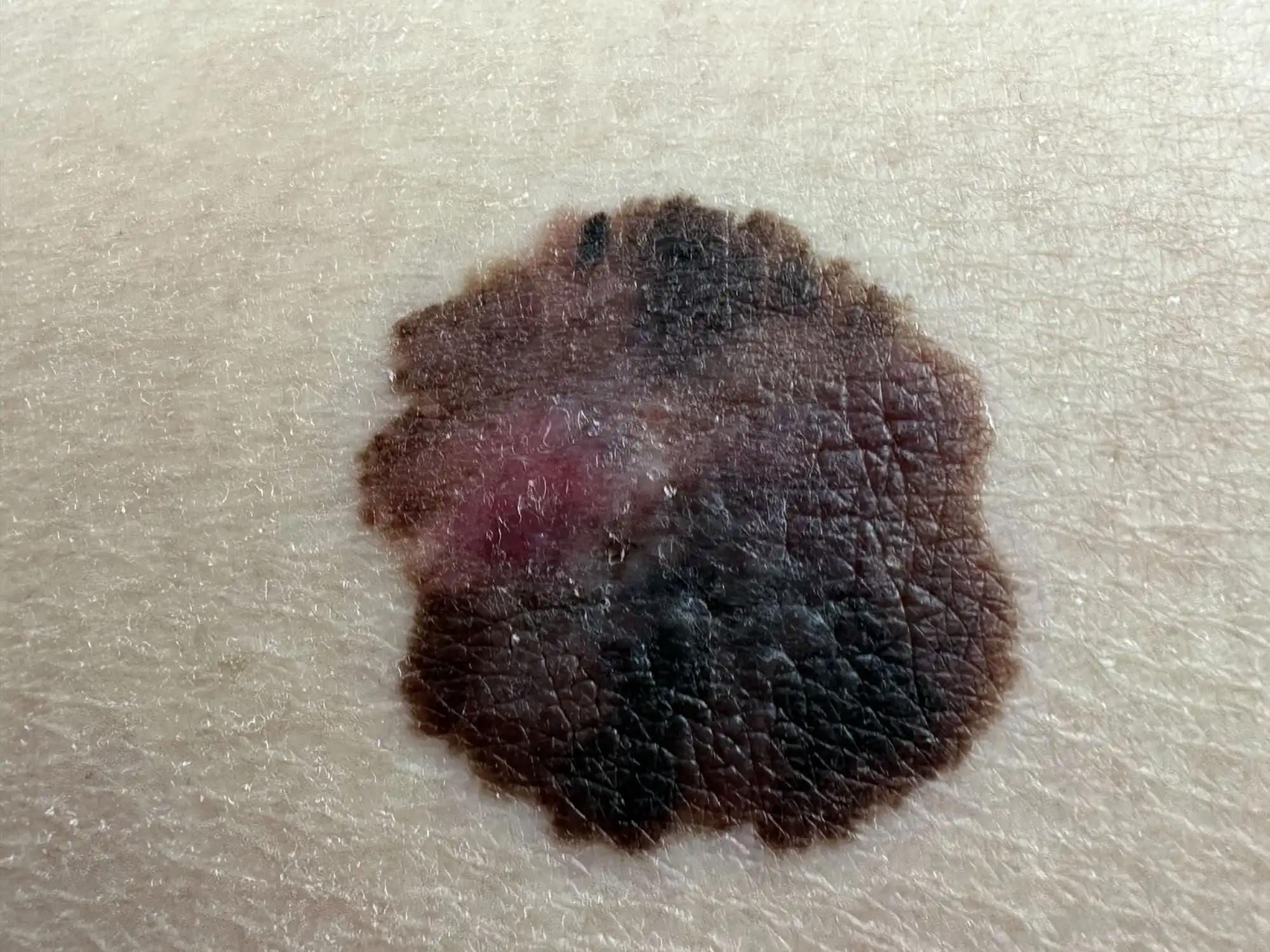 Advanced Melanoma Cancer