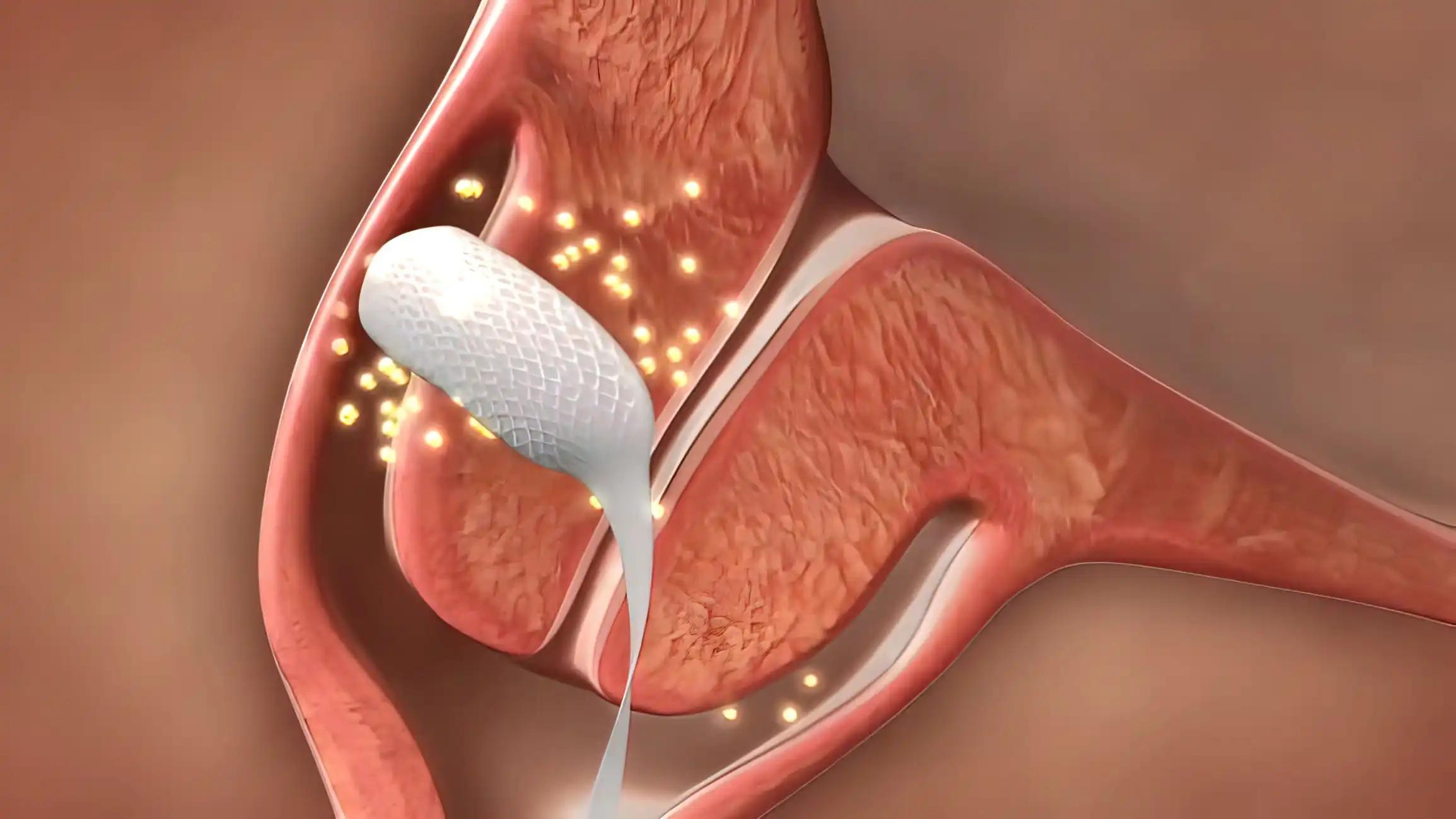 Analysis of 7-Year Olaparib use in Advanced Ovarian Cancer.