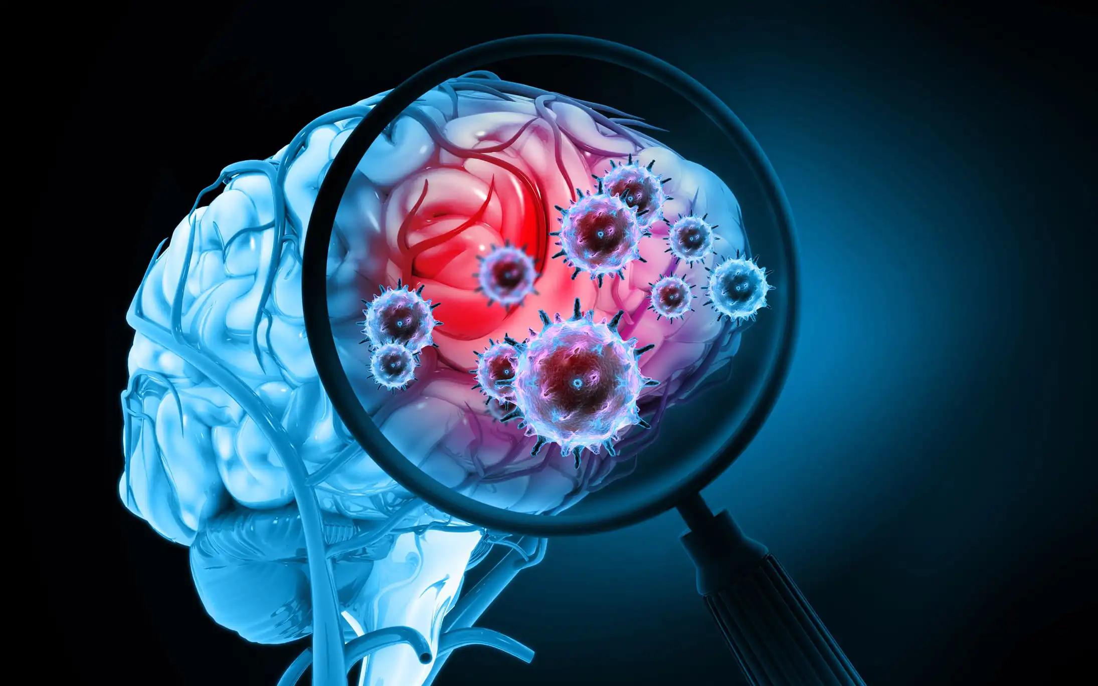 Autologous Tumor Lysate Glioblastoma