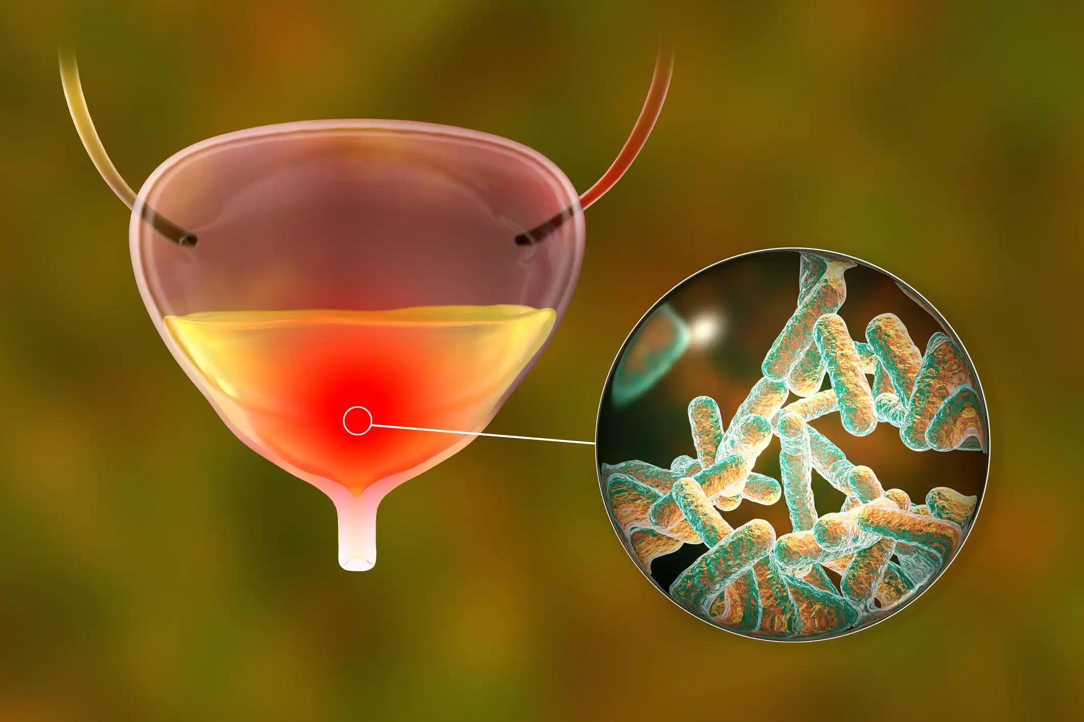 Avelumab vs. Standard Care for Advanced Bladder Cancer