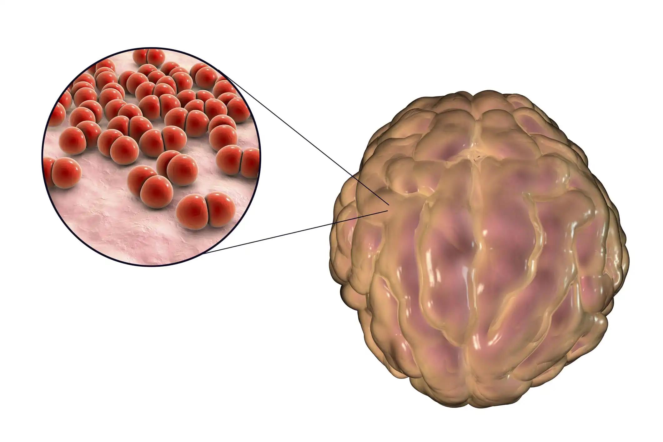 Bacterial Meningitis Infection in the Brain