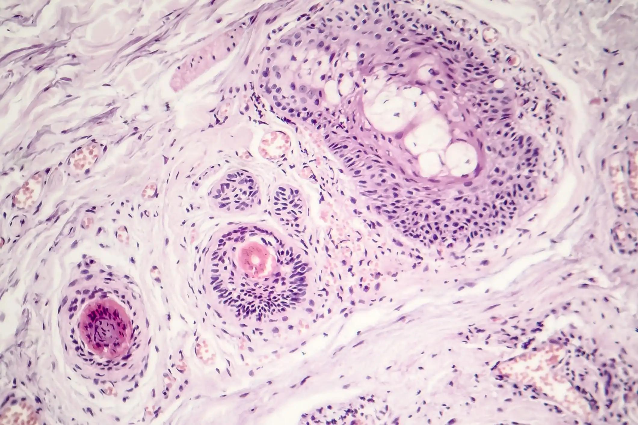 Basal Cell Carcinoma Infection Under Microscope