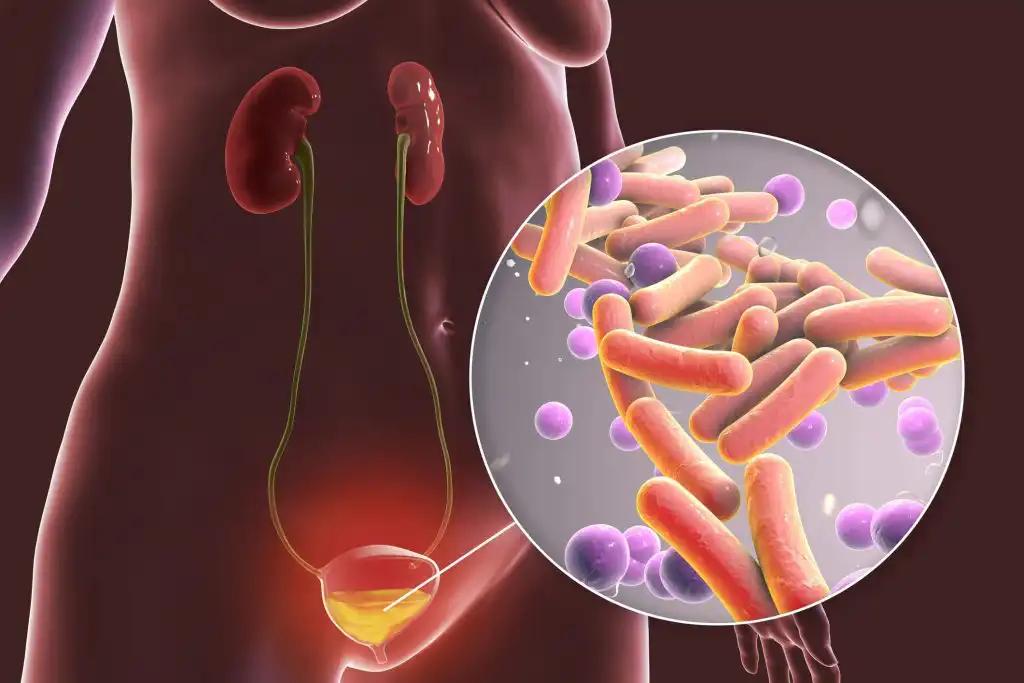 Differential Expression of Bacterial Microbiome in Bladder Cancer Progression and Treatment Implications