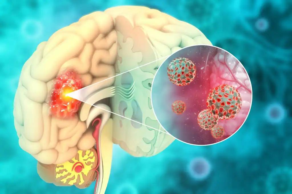 3d illustration Brain Cancer Tumor Inside Brain