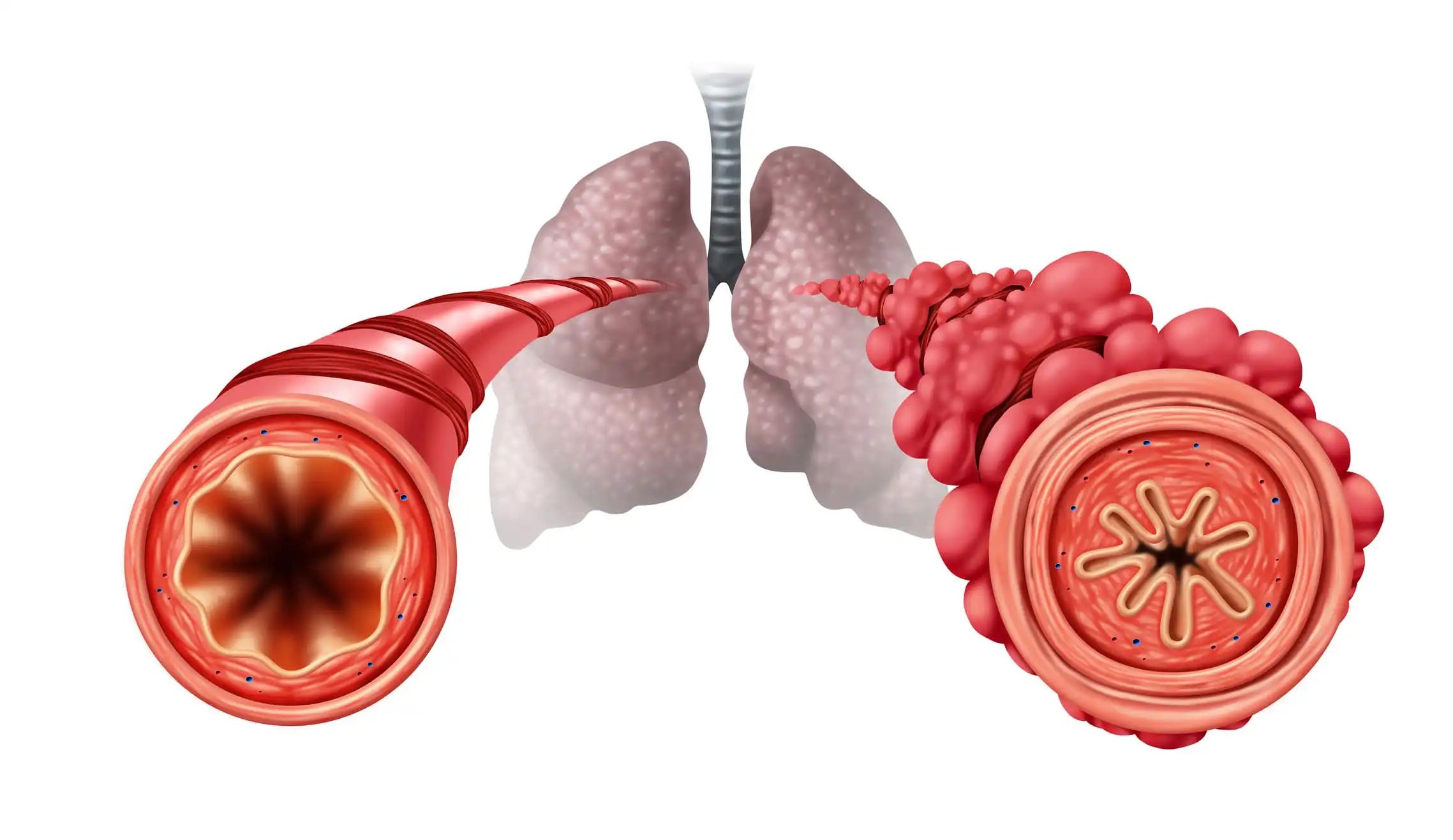 Bronchiolitis Virus Infection 