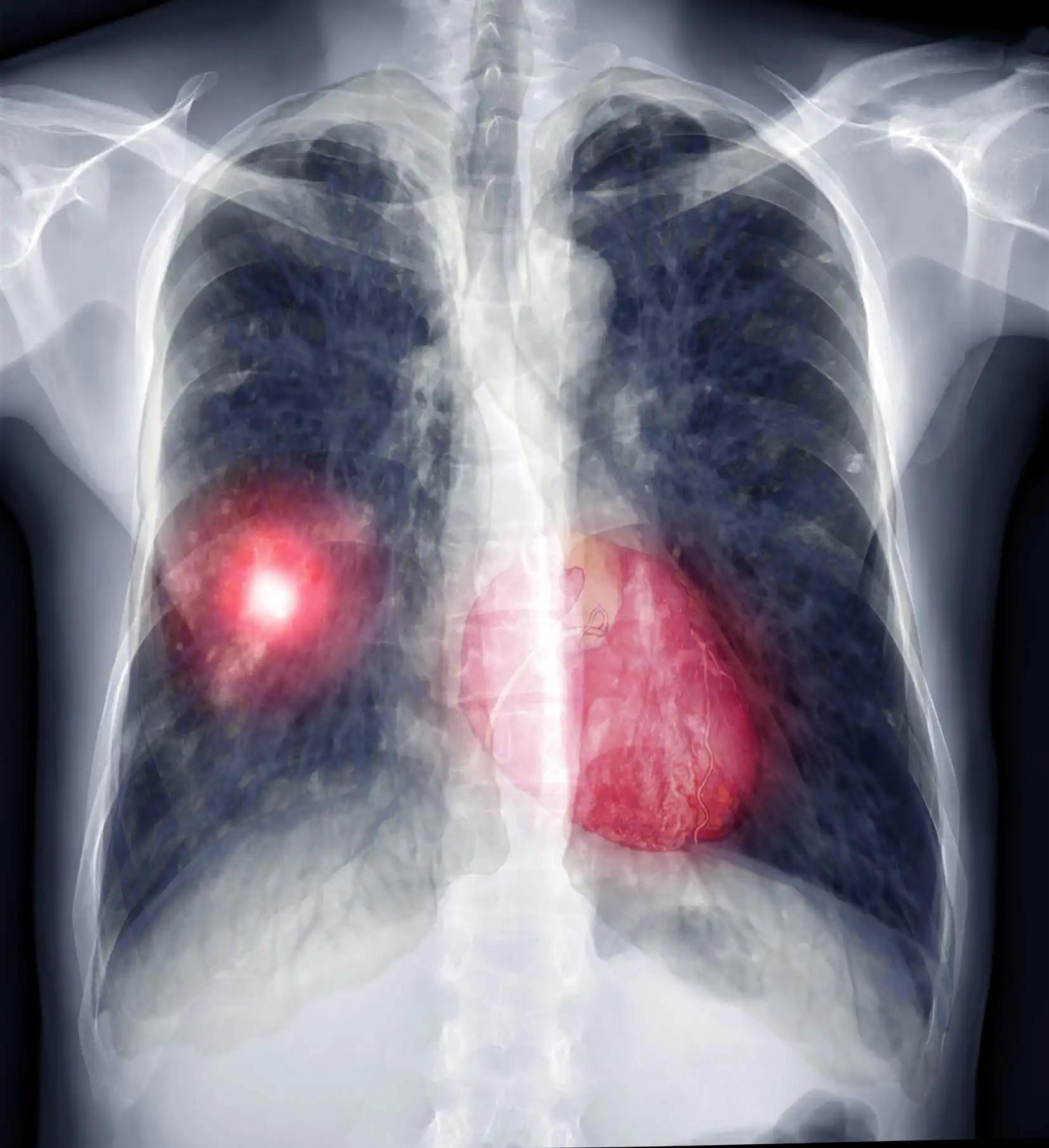 Chest X-Ray Metastatic Lung Cancer