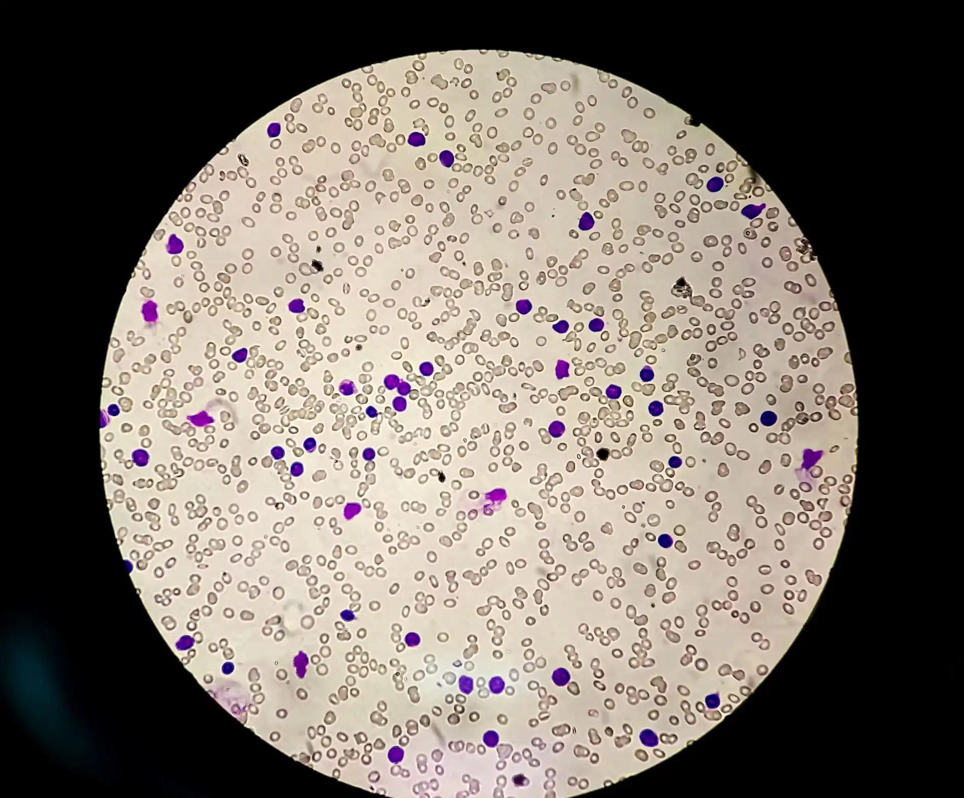 Chronic Lymphocytic Leukemia Blood Cells