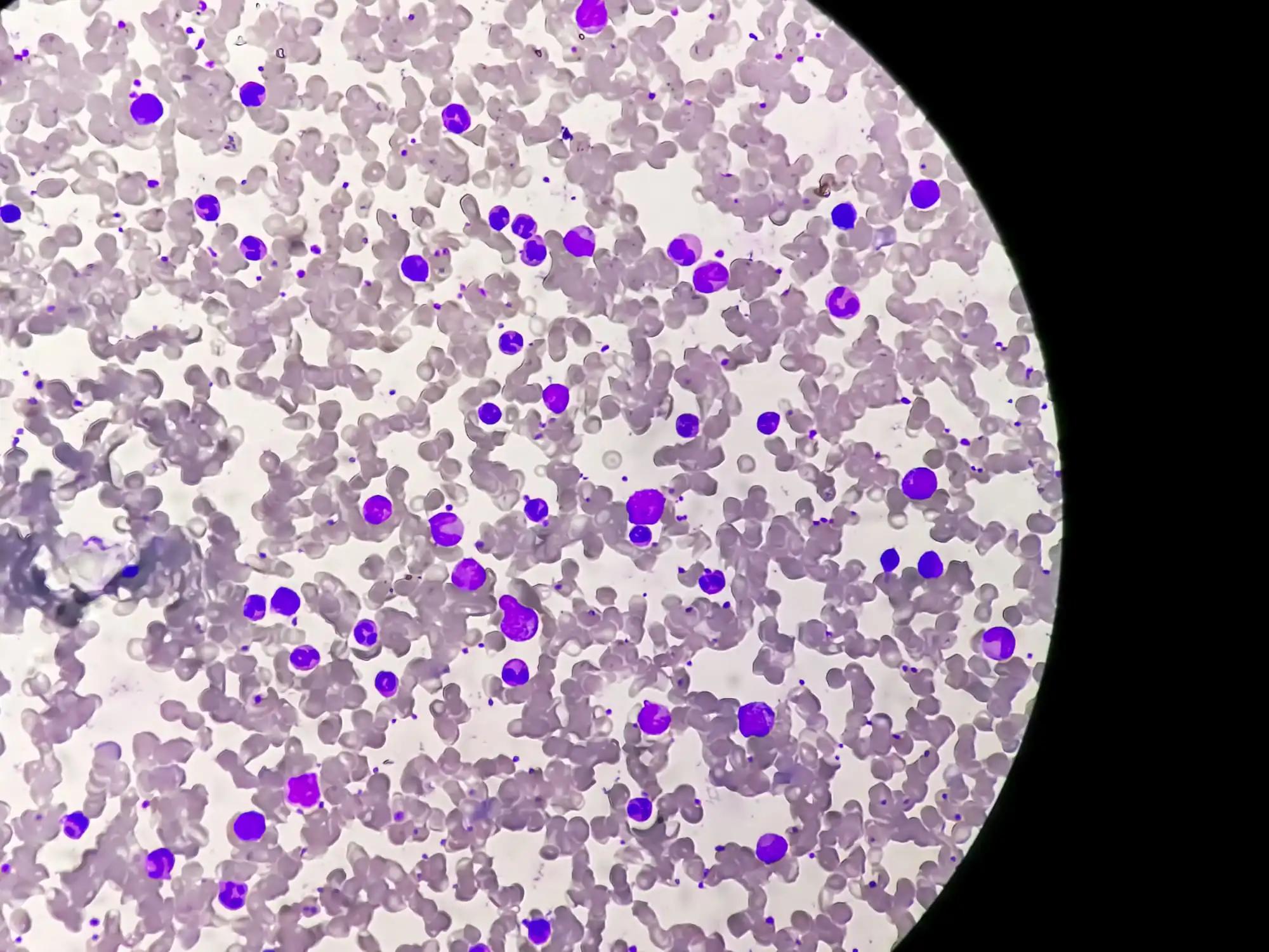 Chronic Myelogenous Leukemia