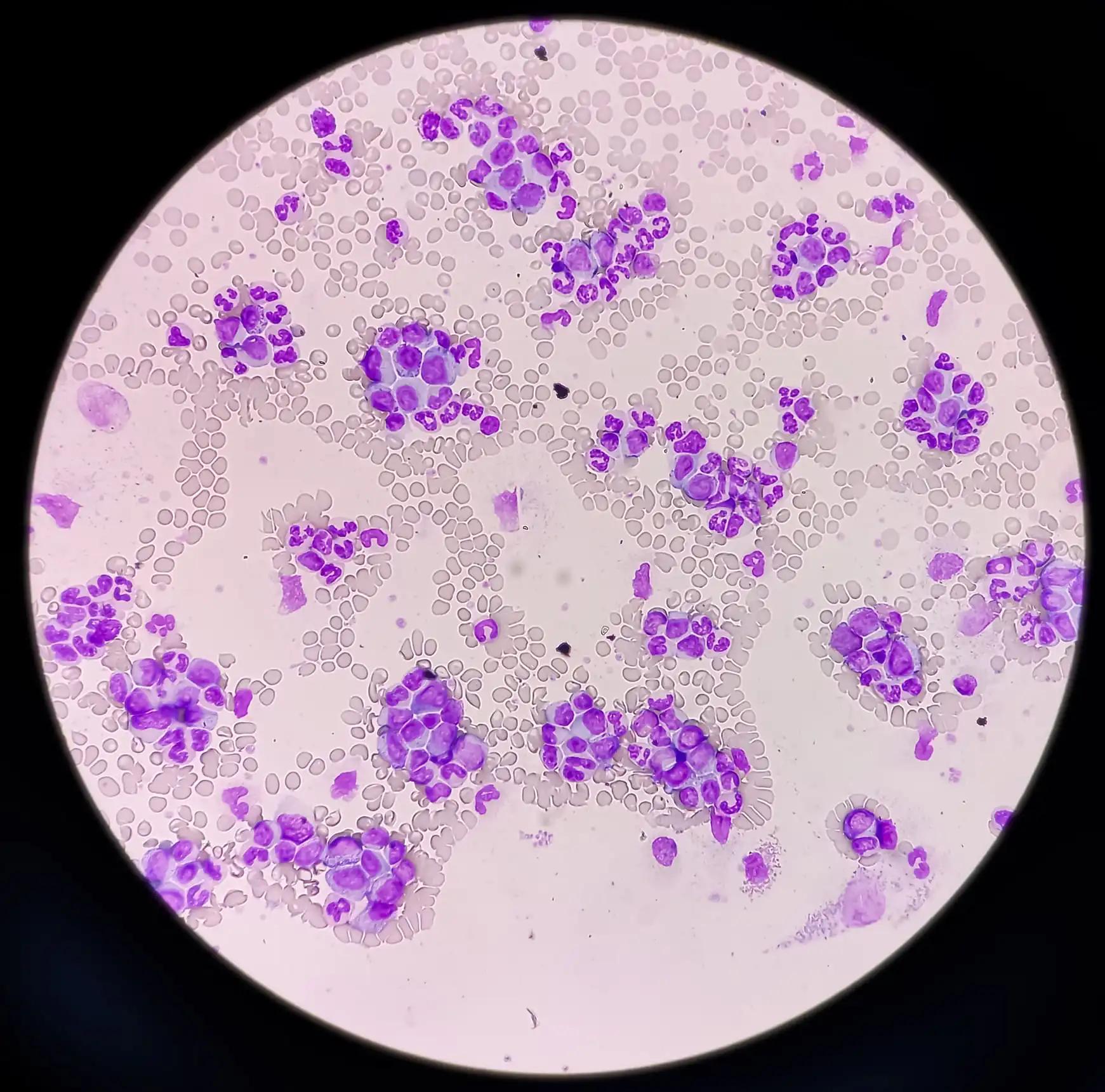 Chronic Myeloid Leukemia Red Blood Cell