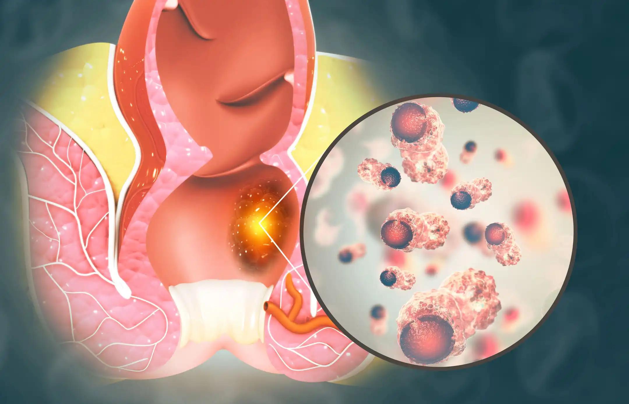 Close-up View of Haemorrhoids (piles) Infection 