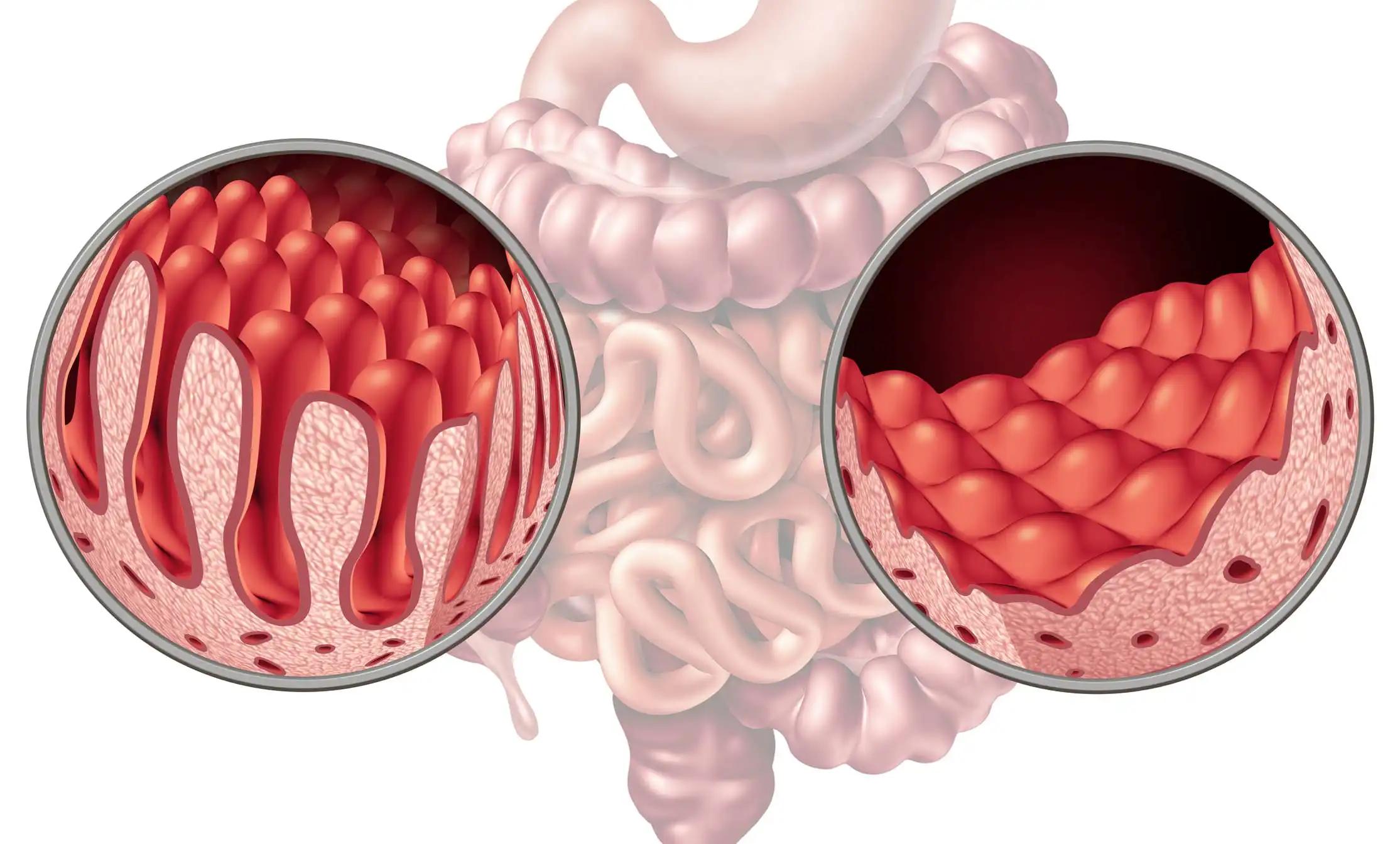 Coeliac Intestine Disease Damage Small Bowel Lining