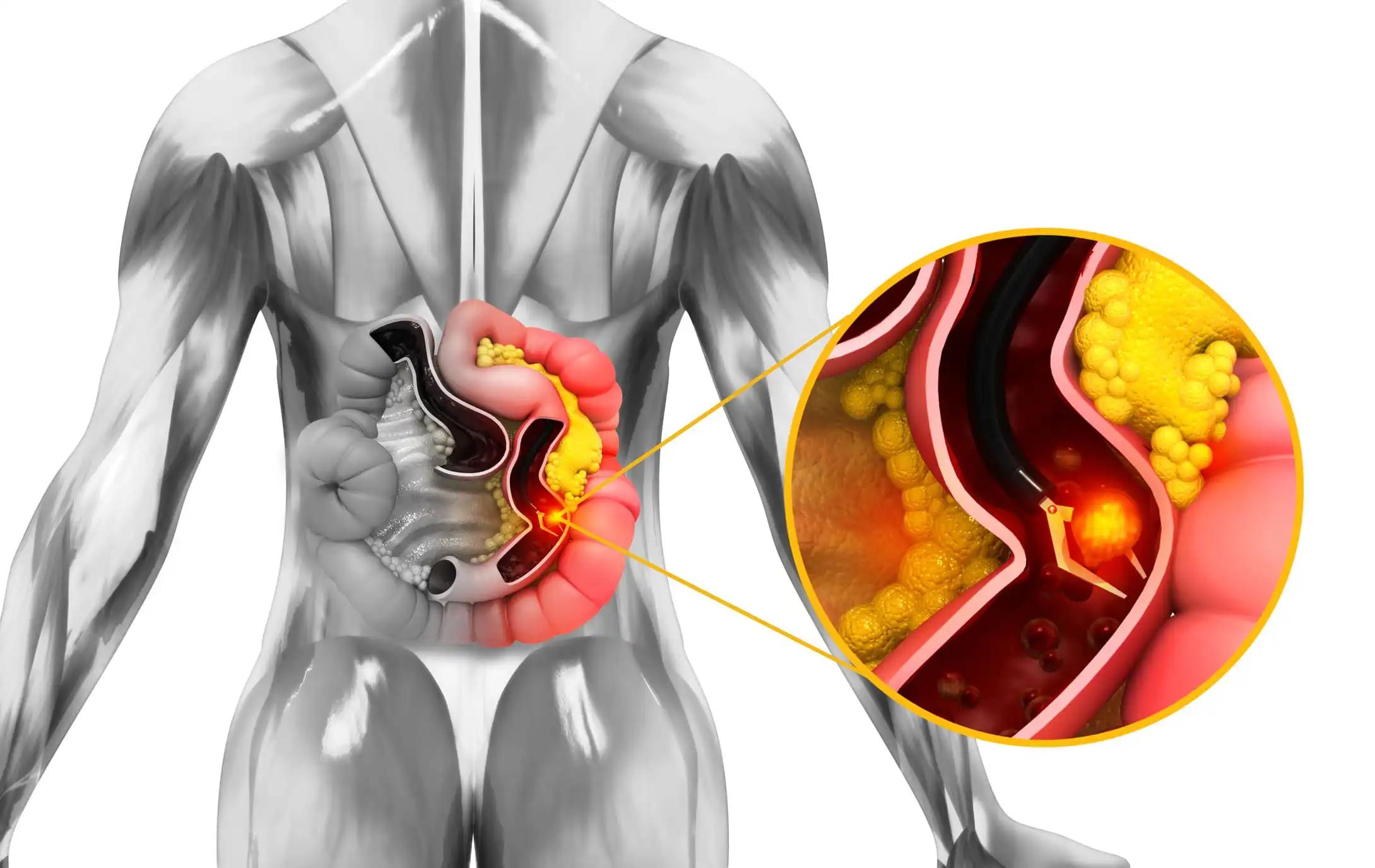 Colon Cancer Colonoscope in Colon