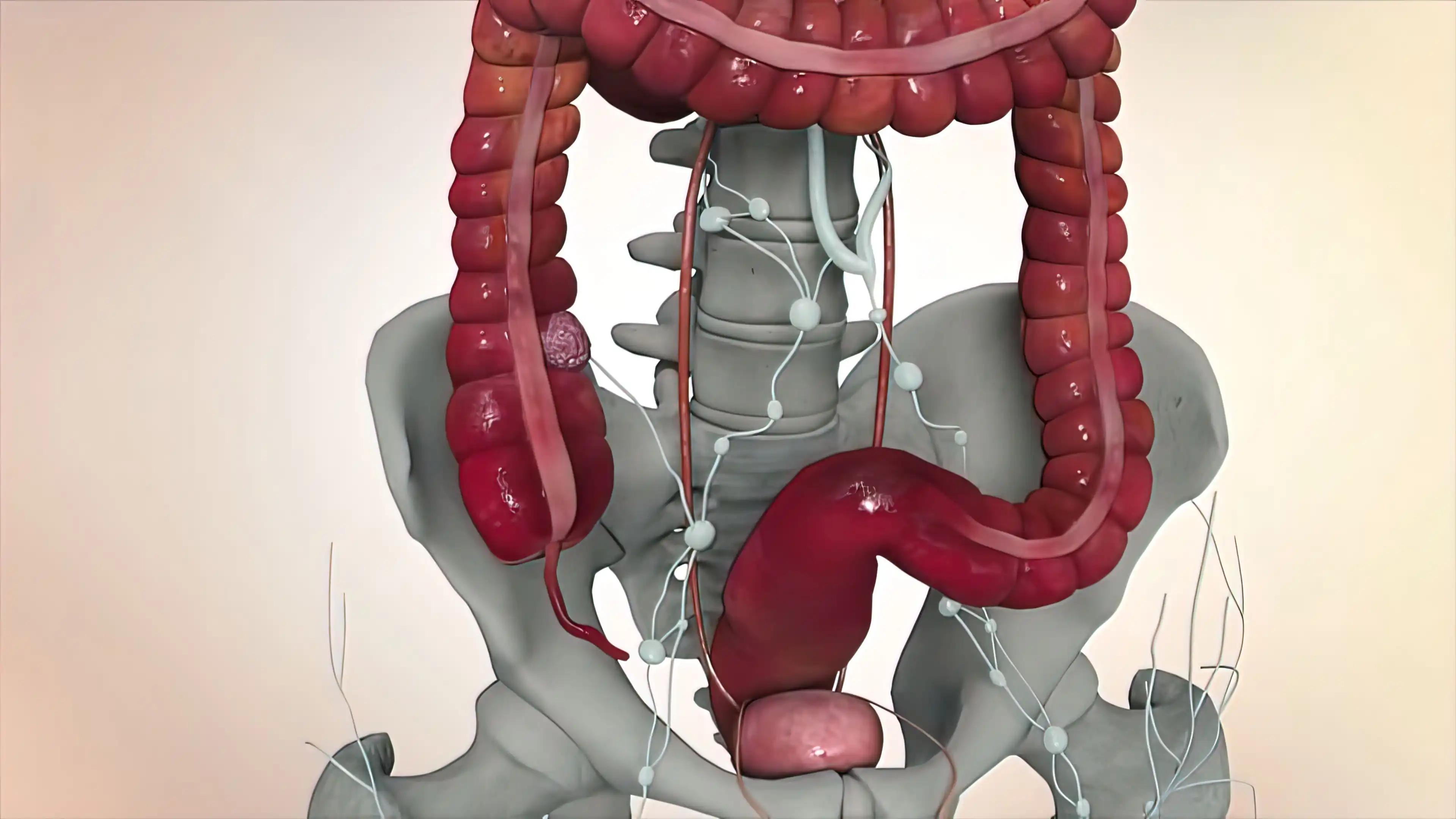 Colon During a Enteroscopy With a Bowel Cancer Tumor