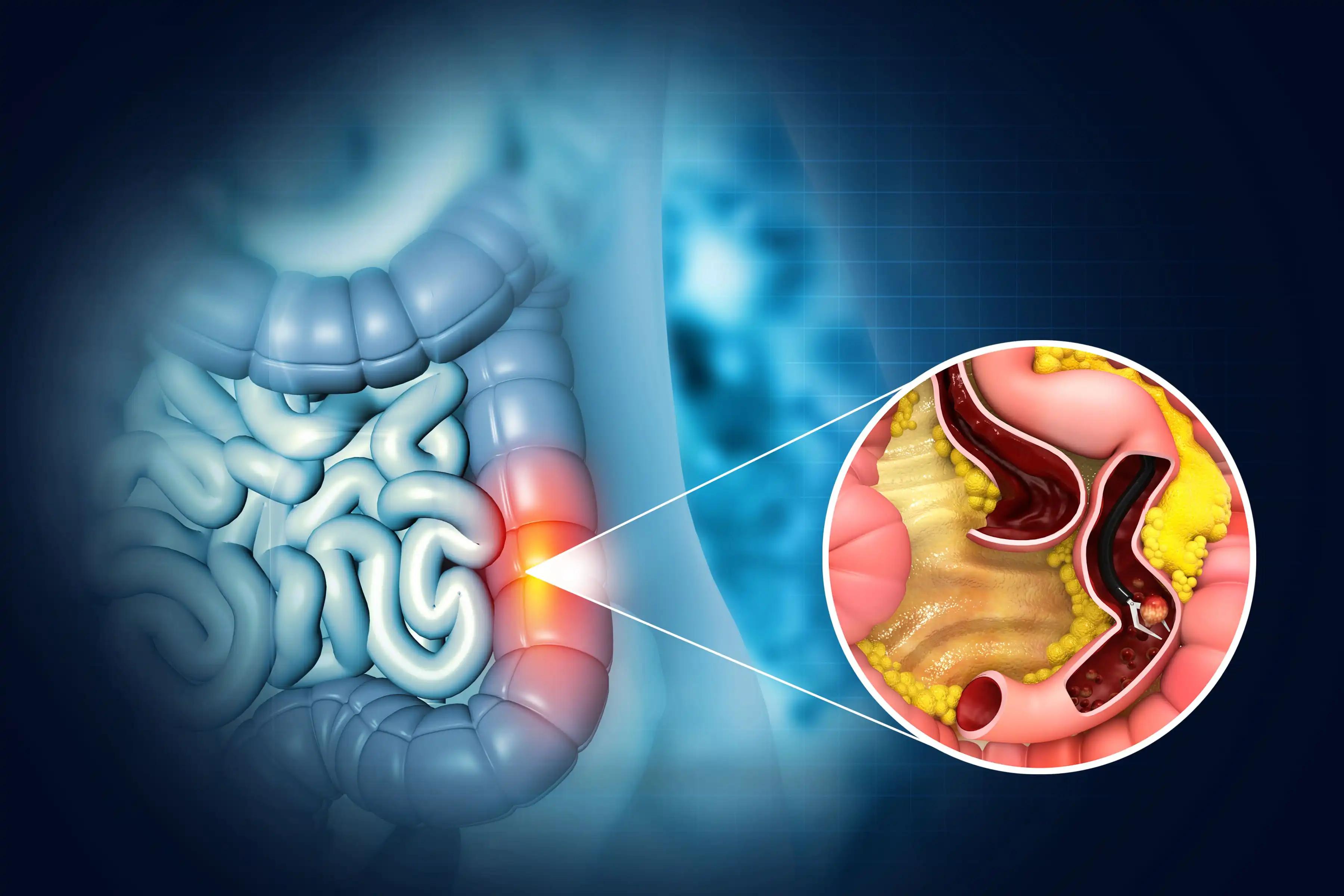 Colonoscopy Colon Polyps