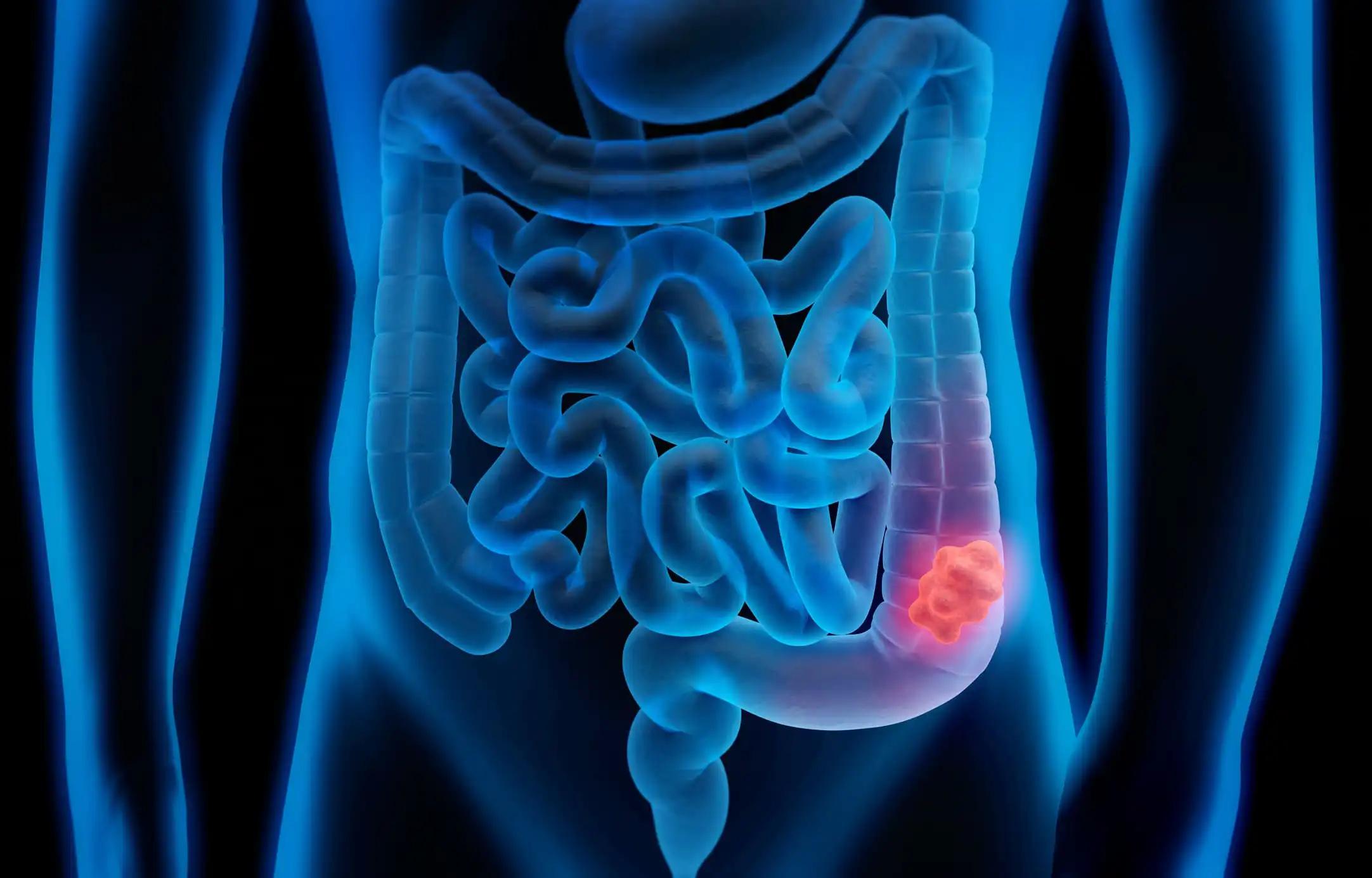 Colorectal Cancer Cell in Intestine